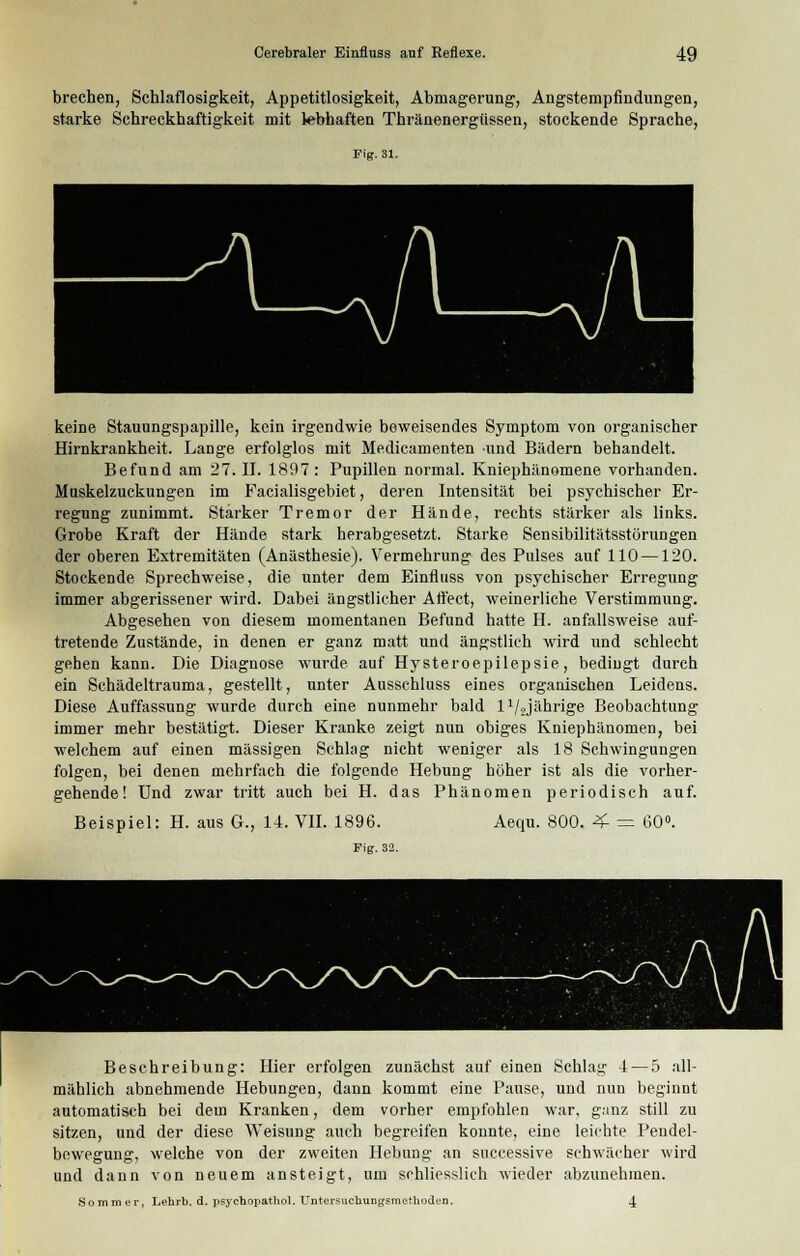 brechen, Schlaflosigkeit, Appetitlosigkeit, Abmagerung, Angstempfindungen, starke Schreckhaftigkeit mit lebhaften Thränenergüssen, stockende Sprache, Fig. 31. keine Stauungspapille, kein irgendwie beweisendes Symptom von organischer Hirnkrankheit. Lange erfolglos mit Medicamenten und Bädern behandelt. Befund am 27. II. 1897: Pupillen normal. Kniephänomene vorhanden. Mnskelzuckungen im Facialisgebiet, deren Intensität bei psychischer Er- regung zunimmt. Starker Tremor der Hände, rechts stärker als links. Grobe Kraft der Hände stark herabgesetzt. Starke Sensibilitätsstörungen der oberen Extremitäten (Anästhesie). Vermehrung des Pulses auf 110 —120. Stockende Sprechweise, die unter dem Einfluss von psychischer Erregung immer abgerissener wird. Dabei ängstlicher Affect, weinerliche Verstimmung. Abgesehen von diesem momentanen Befund hatte H. anfallsweise auf- tretende Zustände, in denen er ganz matt und ängstlich wird und schlecht gehen kann. Die Diagnose wurde auf Hysteroepilepsie, bedingt durch ein Schädeltrauma, gestellt, unter Ausschluss eines organischen Leidens. Diese Auffassung wurde durch eine nunmehr bald 11/2jährig-e Beobachtung immer mehr bestätigt. Dieser Kranke zeigt nun obiges Kniephänomen, bei welchem auf einen massigen Schlag nicht weniger als 18 Schwingungen folgen, bei denen mehrfach die folgende Hebung höher ist als die vorher- gehende! und zwar tritt auch bei H. das Phänomen periodisch auf. Beispiel: H. aus G., IL VII. 1896. Aequ. 800. 4- — 60°. Fig. 32. . Beschreibung: Hier erfolgen zunächst auf einen Schlag 4 — 5 all- mählich abnehmende Hebungen, dann kommt eine Pause, und nun beginnt automatisch bei dem Kranken, dem vorher empfohlen war, ganz still zu sitzen, und der diese Weisung auch begreifen konnte, eine leichte Pendel- bewegung, welche von der zweiten Hebung an successive schwächer wird und dann von neuem ansteigt, um schliesslich wieder abzunehmen. Sommer, Lehrb. d. psychopathol. Untersuchungsmelhoden. 4