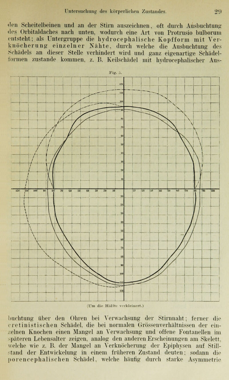 den Scheitelbeinen und an der Stirn auszeichnen, oft durch Ausbuchtung des Orbitaldaches nach unten, wodurch eine Art von Protrusio bulboruni entsteht; als Untergruppe die hydrocephalische Kopfform mit Ver- knöcherung einzelner Nähte, durch welche die Ausbuchtung des Schädels an dieser Stelle verhindert wird und ganz eigenartige Schädel- fonnen zustande kommen, z. B, Keilschädel mit hydrocephalischer Aus- Fig ! i «o 1 ! 1—*1 Uli '---- 1 ' A^ 1 l«1 N. \ ' • '■<- * ~- [ 90 ^ r V ' \s^\^- 1 1 M - <bs| ' \ 1 £. A » \i\ \ 1 , < ! L i r GH 1 V \ ' / i- J± SO M 1 7 1 r w 1 \ , 1 \ \ / 1 / ' 1 1 M 1 I \ \l 1 i i/ r 20 -,-J, 1 \ , 10 ! / \ / 121 HU tuol SO Bl 70 gu w; W 30 20 10 10 13 u U iO H M 70 ii 90 lftu 20 1 \ i r 30 \ \ 1 40 ~T \ i 1 N\ SO T 1 KO i < f/\ K ! |_ 70 ! ; 1 / \ 80 // \ \ /1 1 ^ r ! 1 X. ^S-^--—hu -=£Z^^ r ! IM i . 1 (Um die Hüllt, verkleinert.) buchtung über den Ohren bei Verwachsung der Stirnnaht: ferner die cretinistischen Schädel, die bei normalen Grössenverhältnissen der ein- zelnen Knochen einen Mangel an Verwachsung und offene Fontanellen im späteren Lebensalter zeigen, analog den anderen Erscheinungen am Skelett. welche wie z. Ii. der Mangel an Verknöcherung der Epiphvsen auf Still- stand der Entwickelung in einem früheren Zustand deuten: sodann die porencephalischen Schädel, welche häufig durch starke Asymmetrie