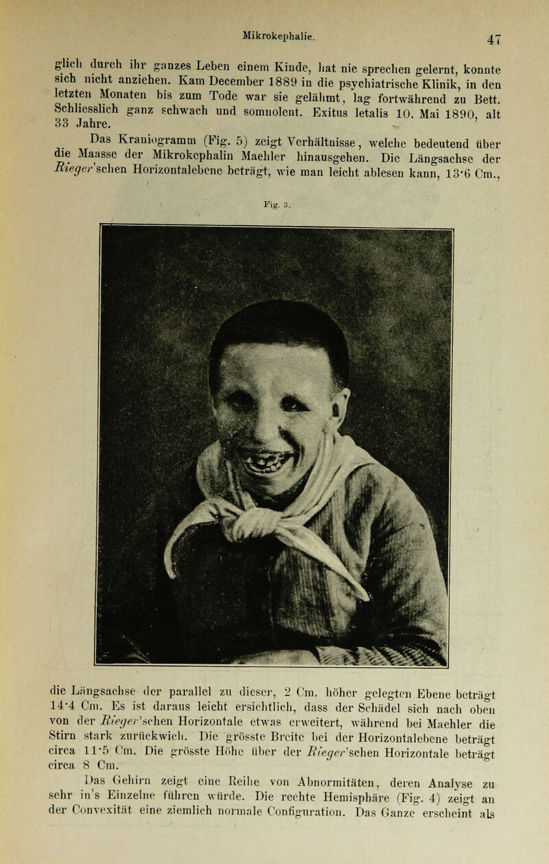 glich durch ihr ganzes Leben einem Kinde, hat nie sprechen gelernt, konnte sich nicht anziehen. Kam December 1889 in die psychiatrische Klinik, in den letzten Monaten bis zum Tode war sie gelähmt, lag fortwährend zu Bett. Schliesslich ganz schwach und somnolent. Exitus letalis 10. Mai 1890 alt 33 Jahre. Das Kraniogramm (Fig. 5) zeigt Verhältnisse, welche bedeutend über die Maasse der Mikrokcphalin Maehler hinausgehen. Die Längsachse der Rieger'sehen Horizontalebene beträgt, wie man leicht ablesen kann, 13-6 Cm., Fig. 3. die Längsachse der parallel zu dieser, 2 Cm. höher gelegten Ebene beträgt 14-4 Cm. Es ist daraus leicht ersichtlich, dass der Schädel sich nach oben von der Rteger'sehen Horizontale etwas erweitert, während bei Maehler die Stirn stark zurückwich. Die grösste Breite bei der Horizontalebene beträgt circa 11-5 Cm. Die grösste Höhe über der üVe^r'schen Horizontale beträgt circa 8 Cm. Das Gehirn zeigt eine Reihe von Abnormitäten, deren Analyse zu sehr in's Einzelne führen würde. Die rechte Hemisphäre (Fig. 4) zeigt an der Gonvexität eine ziemlich normale Configuration. Das Ganze erscheint als