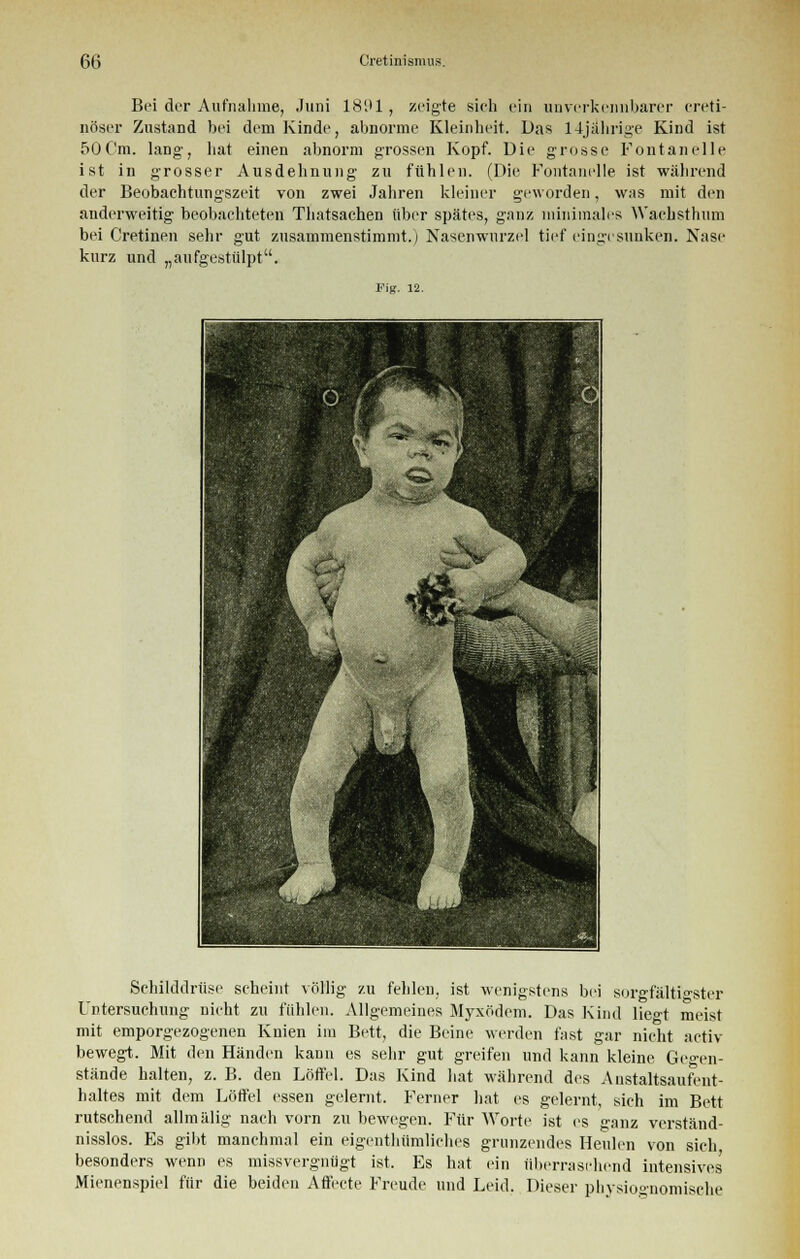 Bei der Aufnahme, Juni 1891, zeigte sich ein unverkennbarer creti- nöser Zustand bei dem Kinde, abnorme Kleinheit. Das 14jährige Kind ist 500m. lang, hat einen abnorm grossen Kopf. Die grosse Fontanelle ist in grosser Ausdehnung zu fühlen. (Die Fontanelle ist während der Beobachtungszeit von zwei Jahren kleiner geworden, was mit den anderweitig beobachteten Thatsachen über spätes, ganz minimales Wachsthum bei Cretinen sehr gut zusammenstimmt.) Nasenwurzel tief eingesunken. Nase kurz und „aufgestülpt. Fig. 12. Schilddrüse scheint völlig zu fehlen, ist wenigstens bei sorgfältigster Untersuchung nicht zu fühlen. Allgemeines Myxödem. Das Kind lie°-t meist mit emporgezogenen Knien im Bett, die Beine werden fast gar nicht activ bewegt. Mit den Händen kann es sehr gut greifen und kann kleine Gegen- stände halten, z. B. den Löffel. Das Kind hat während des Anstaltsaufent- haltes mit dem Löffel essen gelernt. Ferner hat es gelernt, sich im Bett rutschend allmälig nach vorn zu bewegen. Für Worte ist es ganz verständ- nisslos. Es gibt manchmal ein eigentümliches grunzendes Heulen von sich besonders wenn es missvergniigt ist. Es hat ein überraschend intensives' Mienenspiel für die beiden Affecte Freude und Leid. Dieser physiognomisehe