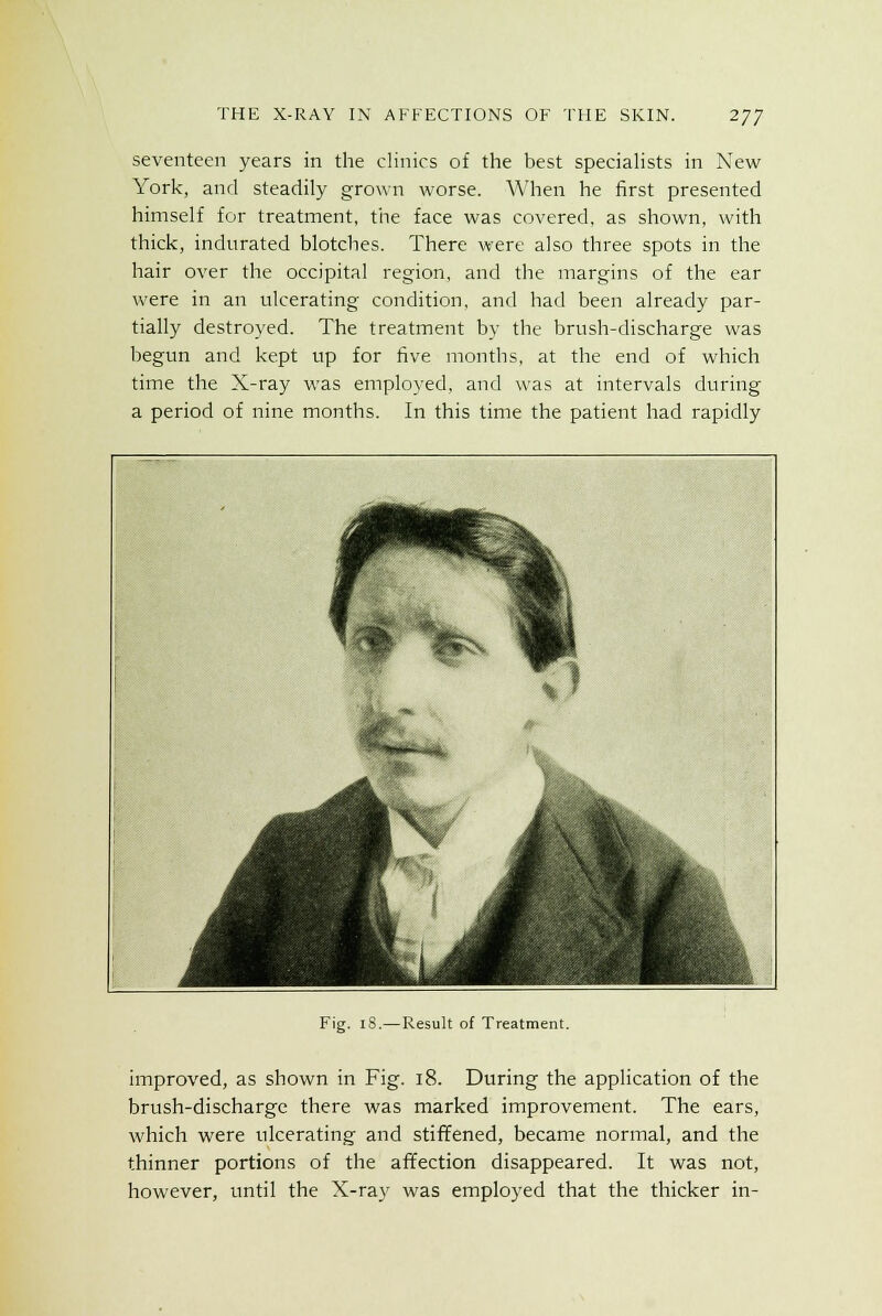 seventeen years in the clinics of the best specialists in New York, and steadily grown worse. When he first presented himself for treatment, the face was covered, as shown, with thick, indurated blotches. There were also three spots in the hair over the occipital region, and the margins of the ear were in an ulcerating condition, and had been already par- tially destroyed. The treatment by the brush-discharge was begun and kept up for five months, at the end of which time the X-ray was employed, and was at intervals during a period of nine months. In this time the patient had rapidly Fig. iS.—Result of Treatment. improved, as shown in Fig. 18. During the application of the brush-discharge there was marked improvement. The ears, which were ulcerating and stiffened, became normal, and the thinner portions of the affection disappeared. It was not, however, until the X-ray was employed that the thicker in-