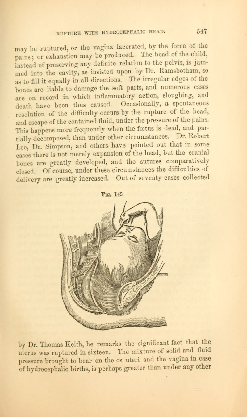 BUPTUEE WITH HYDROCEPHALIC HEAD. may be ruptured, or the vagina lacerated, by the force of the pains; or exhaustion may be produced. The head of the child, instead of preserving any definite relation to the pelvis, is jam- med into the cavity, as insisted upon by Dr. Eamsbotham, so as to till it equally in all directions. The irregular edges of the bones are liable to damage the soft parts, and numerous cases are on record in which inflammatory action, sloughing, and death have been thus caused. Occasionally, a spontaneous resolution of the difficulty occurs by the rupture of the head, and escape of the contained fluid, under the pressure of the pains. This happens more frequently when the foetus is dead, and par- tially decomposed, than under other circumstances. Dr. Kobert Lee, Dr. Simpson, and others have pointed out that in some g there is not merely expansion of the head, but the cranial es are greatly developed, and the sutures comparatively id. Of course, under these circumstances the difficulties of delivery are greatly increased. Out of seventy cases collected Its. 145. by Dr. Thomas Keith, he remarks the significant fact that the uterus was ruptured in sixteen. The mixture of solid and fluid pressure brought to bear on the os uteri and the vagina in case of hydrocephalic births, is perhaps greater than under any other