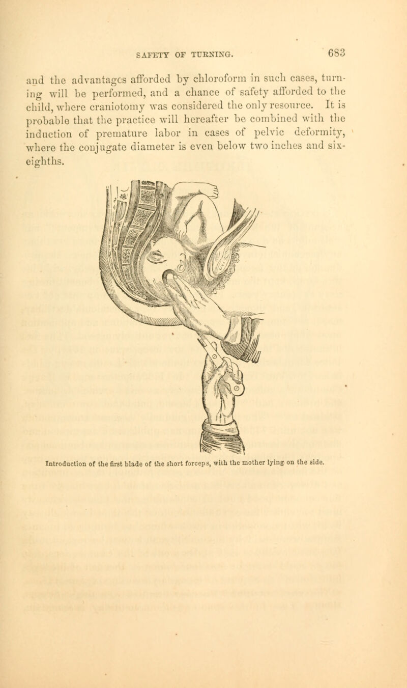 and the advantages afforded by chloroform in such eases, turn- ing will be performed, and a chance of safety afforded to the child, where craniotomy was considered the only resource. It is probable that the practice will hereafter be combined with the induction of premature labor in cases of pelvic deformity, where the conjugate diameter is even below two inches and six- eighths. Introduction of the first blade of the short forceps, with the mother lying on the side.