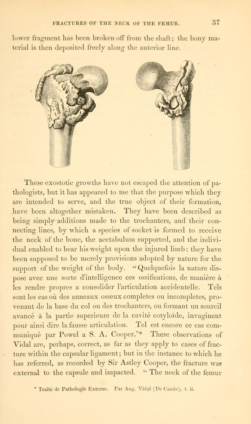 lower fragment has been broken off from the shaft ; the bony ma- terial is then deposited freely along the anterior line. These exostotic growths have not escaped the attention of pa- thologists, but it has appeared to me that the purpose which they are intended to serve, and the true object of their formation, have been altogether mistaken. They have been described as being simply additions made to the trochanters, and their con- necting lines, by which a species of socket is formed to receive the neck of the bone, the acetabulum supported, and the indivi- dual enabled to bear his weight upon the injured limb: they have been supposed to be merely provisions adopted by nature for the support of the weight of the body.  Quelquefois la nature dis- pose avec une sorte ^intelligence ces ossifications, de maniere a les rendre propres a consolider l'articulation accidentelle. Tels sont les cas ou des anneaux osseux completes ou incompletes, pro- venant de la base du col ou des trochanters, ou formant un sourcil avance a la partie superieure de la cavite cotylo'ide, invaginent pour ainsi dire la fausse articulation. Tel est encore ce cas com- munique par Powel a S. A. Cooper.* These observations of Vidal are, perhaps, correct, as far as they apply to cases of frac- ture within the capsular ligament; but in the instance to which he has referred, as recorded by Sir Astley Cooper, the fracture was external to the capsule and impacted.  The neck of the femur * Traite de Pathologie Externe. Par Aug. Vidal (De Cassis), t. ii.