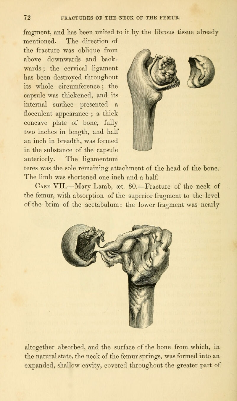 fragment, and lias been united to it by the fibrous tissue already mentioned. The direction of the fracture was oblique from above downwards and back- wards ; the cervical ligament has been destroyed throughout its whole circumference; the capsule was thickened, and its internal surface presented a flocculent appearance ; a thick concave plate of bone, fully two inches in length, and half an inch in breadth, was formed in the substance of the capsule anteriorly. The ligamentum teres was the sole remaining attachment of the head of the bone. The limb was shortened one inch and a half. Case VII.—Mary Lamb, set 80.—Fracture of the neck of the femur, with absorption of the superior fragment to the level of the brim of the acetabulum: the lower fragment was nearly altogether absorbed, and the surface of the bone from which, in the natural state, the neck of the femur springs, was formed into an expanded, shallow cavity, covered throughout the greater part of