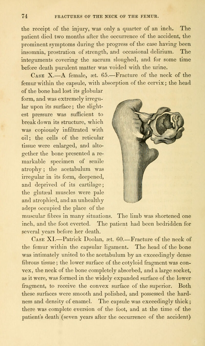 the receipt of the injury, was only a quarter of an inch. The patient died two months after the occurrence of the accident, the prominent symptoms during the progress of the case having been insomnia, prostration of strength, and occasional delirium. The integuments covering the sacrum sloughed, and for some time before death purulent matter was voided with the urine. Case X.—A female, set. 65.—Fracture of the neck of the femur within the capsule, with absorption of the cervix; the head of the bone had lost its globular form, and was extremely irregu- ^^^^ lar upon its surface; the slight- est pressure was sufficient to break down its structure, which was copiously infiltrated with oil; the cells of the reticular tissue were enlarged, and alto- gether the bone presented a re- markable specimen of senile atrophy; the acetabulum was irregular in its form, deepened, and deprived of its cartilage; the gluteal muscles were pale and atrophied, and an unhealthy adeps occupied the place of the muscular fibres in many situations. The limb was shortened one inch, and the foot everted. The patient had been bedridden for several years before her death. Case XI.—Patrick Doolan, set. 60.—Fracture of the neck of the femur within the capsular ligament. The head of the bone was intimately united to the acetabulum by an exceedingly dense fibrous tissue; the lower surface of the cotyloid fragment was con- vex, the neck of the bone completely absorbed, and a large socket, as it were, was formed in the widely expanded surface of the lower fragment, to receive the convex surface of the superior. Both these surfaces were smooth and polished, and possessed the hard- ness and density of enamel. The capsule was exceedingly thick; there was complete eversion of the foot, and at the time of the patient's death (seven years after the occurrence of the accident)