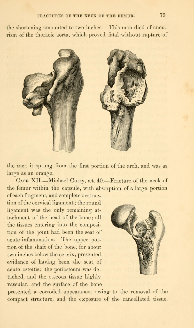 the shortening amounted to two inches. This man died of aneu- rism of the thoracic aorta, which proved fatal without rupture of the sac; it sprung from the first portion of the arch, and was as large as an orange. Case XII.—Michael Curry, set. 40.—Fracture of the neck of the femur within the capsule, with absorption of a large portion of each fragment, and complete destruc- tion of the cervical ligament; the round ligament was the only remaining at- tachment of the head of the bone; all the tissues entering into the composi- tion of the joint had been the seat of acute inflammation. The upper por- tion of the shaft of the bone, for about two inches below the cervix, presented evidence of having been the seat of acute osteitis; the periosteum was de- tached, and the osseous tissue highly vascular, and the surface of the bone presented a corroded appearance, owing to the removal of the compact structure, and the exposure of the cancellated tissue.