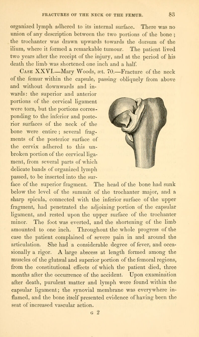 organized lymph adhered to its internal surface. There was no union of any description between the two portions of the bone ; the trochanter was drawn upwards towards the dorsum of the ilium, where it formed a remarkable tumour. The patient lived two years after the receipt of the injury, and at the period of his death the limb was shortened one inch and a half. Case XXVI.—Mary Woods, ait. 70.—Fracture of the neck of the femur within the capsule, passing obliquely from above and without downwards and in- wards: the superior and anterior portions of the cervical ligament were torn, but the portions corres- ponding to the inferior and poste- rior surfaces of the neck of the bone were entire ; several frag- ments of the posterior surface of the cervix adhered to this un- broken portion of the cervical liga- ment, from several parts of which delicate bands of organized lymph passed, to be inserted into the sur- face of the superior fragment. The head of the bone had sunk below the level of the summit of the trochanter major, and a sharp spicula, connected with the inferior surface of the upper fragment, had penetrated the adjoining portion of the capsular ligament, and rested upon the upper surface of the trochanter minor. The foot was everted, and the shortening of the limb amounted to one inch. Throughout the whole progress of the case the patient complained of severe pain in and around the articulation. She had a considerable degree of fever, and occa- sionally a rigor. A large abscess at length formed among the muscles of the glutaeal and superior portion of the femoral regions, from the constitutional effects of which the patient died, three months after the occurrence of the accident. Upon examination after death, purulent matter and lymph were found within the capsular ligament; the synovial membrane was everywhere in- flamed, and the bone itself presented evidence of having been the seat of increased vascular action. g 2