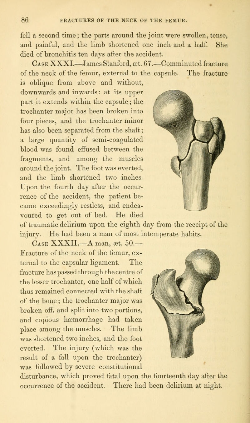 fell a second time; the parts around tlie joint were swollen, tense, and painful, and the limb shortened one inch and a half. She died of bronchitis ten days after the accident. Case XXXI.—James Stanford, Bet. 67.—Comminuted fracture of the neck of the femur, external to the capsule. The fracture is oblique from above and without, downwards and inwards: at its upper part it extends within the capsule; the trochanter major has been broken into four pieces, and the trochanter minor has also been separated from the shaft; a large quantity of semi-coagulated blood was found effused between the fragments, and among the muscles around the joint. The foot was everted, and the limb shortened two inches. Upon the fourth day after the occur- rence of the accident, the patient be- came exceedingly restless, and endea- voured to get out of bed. He died of traumatic delirium upon the eighth day from the receipt of the injury. He had been a man of most intemperate habits. Case XXXII.—A man, aet. 50.— Fracture of the neck of the femur, ex- ternal to the capsular ligament. The fracture has passed through the centre of the lesser trochanter, one half of which thus remained connected with the shaft of the bone; the trochanter major was broken off, and split into two portions, and copious haemorrhage had taken place among the muscles. The limb was shortened two inches, and the foot everted. The injury (which was the result of a fall upon the trochanter) was followed by severe constitutional disturbance, which proved fatal upon the fourteenth day after the occurrence of the accident. There had been delirium at night.