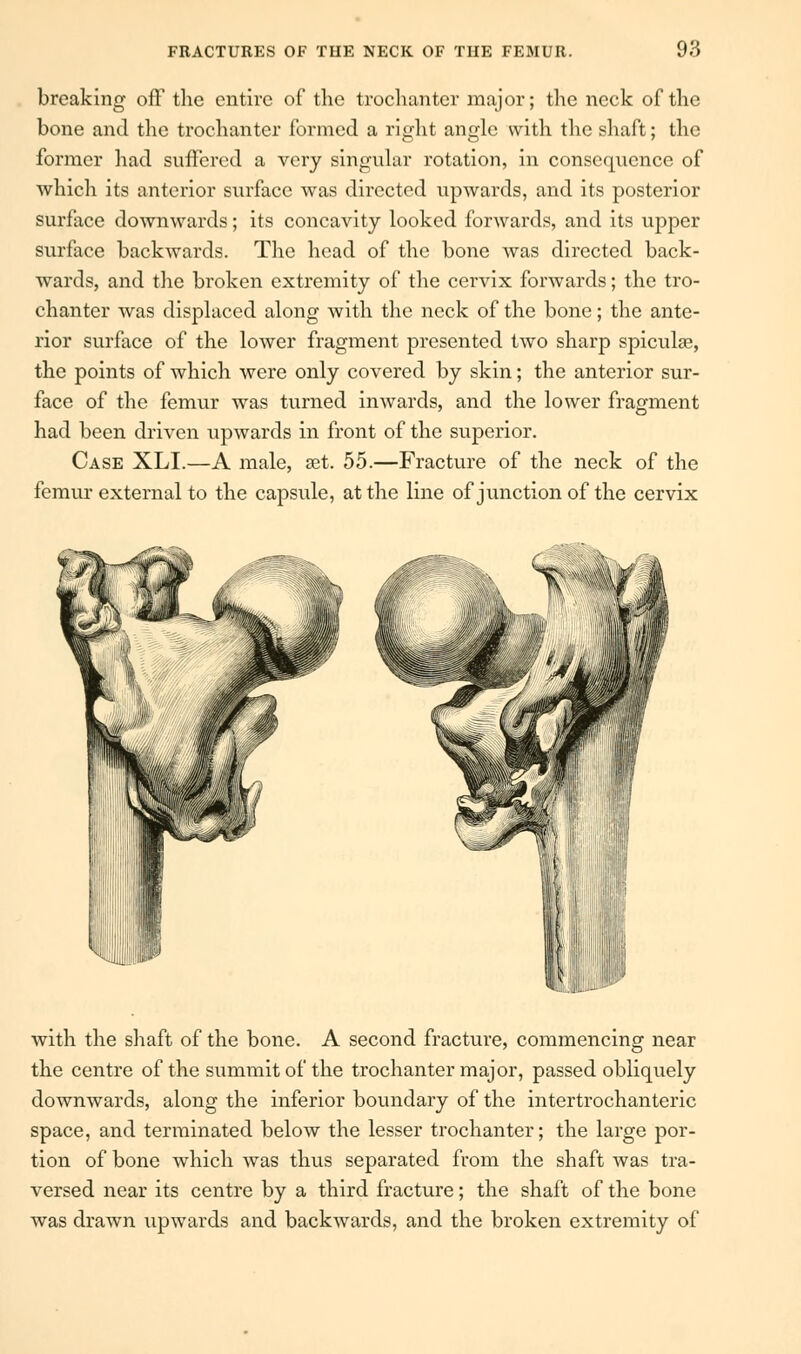 breaking off the entire of the trochanter major; the neck of the bone and the trochanter formed a right angle with the shaft; the former had suffered a very singular rotation, in consequence of which its anterior surface was directed upwards, and its posterior surface downwards; its concavity looked forwards, and its upper surface backwards. The head of the bone was directed back- wards, and the broken extremity of the cervix forwards; the tro- chanter was displaced along with the neck of the bone; the ante- rior surface of the lower fragment presented two sharp spicules, the points of which were only covered by skin; the anterior sur- face of the femur was turned inwards, and the lower fragment had been driven upwards in front of the superior. Case XLI.—A male, set. 55.—Fracture of the neck of the femur external to the capsule, at the line of junction of the cervix with the shaft of the bone. A second fracture, commencing near the centre of the summit of the trochanter major, passed obliquely downwards, along the inferior boundary of the intertrochanteric space, and terminated below the lesser trochanter; the large por- tion of bone which was thus separated from the shaft was tra- versed near its centre by a third fracture; the shaft of the bone was drawn upwards and backwards, and the broken extremity of