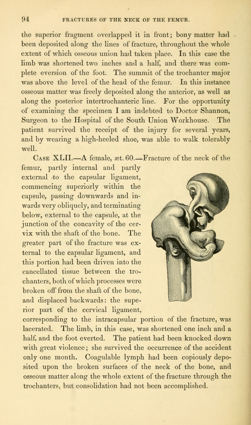 the superior fragment overlapped it in front; bony matter had been deposited along the lines of fracture, throughout the whole extent of which osseous union had taken place. In this case the limb was shortened two inches and a half, and there was com- plete eversion of the foot. The summit of the trochanter major was above the level of the head of the femur. In this instance osseous matter was freely deposited along the anterior, as well as along the posterior intertrochanteric line. For the opportunity of examining the specimen I am indebted to Doctor Shannon, Surgeon to the Hospital of the South Union Workhouse. The patient survived the receipt of the injury for several years, and by wearing a high-heeled shoe, was able to walk tolerably well. Case XLIL—A female, set. 60.—Fracture of the neck of the femur, partly internal and partly external to the capsular ligament, commencing superiorly within the capsule, passing downwards and in- wards very obliquely, and terminating below, external to the capsule, at the junction of the concavity of the cer- vix with the shaft of the bone. The greater part of the fracture was ex- ternal to the capsular ligament, and this portion had been driven into the cancellated tissue between the tro- chanters, both of which processes were broken off from the shaft of the bone, and displaced backwards: the supe- rior part of the cervical ligament, corresponding to the intracapsular portion of the fracture, was lacerated. The limb, in this case, was shortened one inch and a half, and the foot everted. The patient had been knocked down with great violence; she survived the occurrence of the accident only one month. Coagulable lymph had been copiously depo- sited upon the broken surfaces of the neck of the bone, and osseous matter along the whole extent of the fracture through the trochanters, but consolidation had not been accomplished.