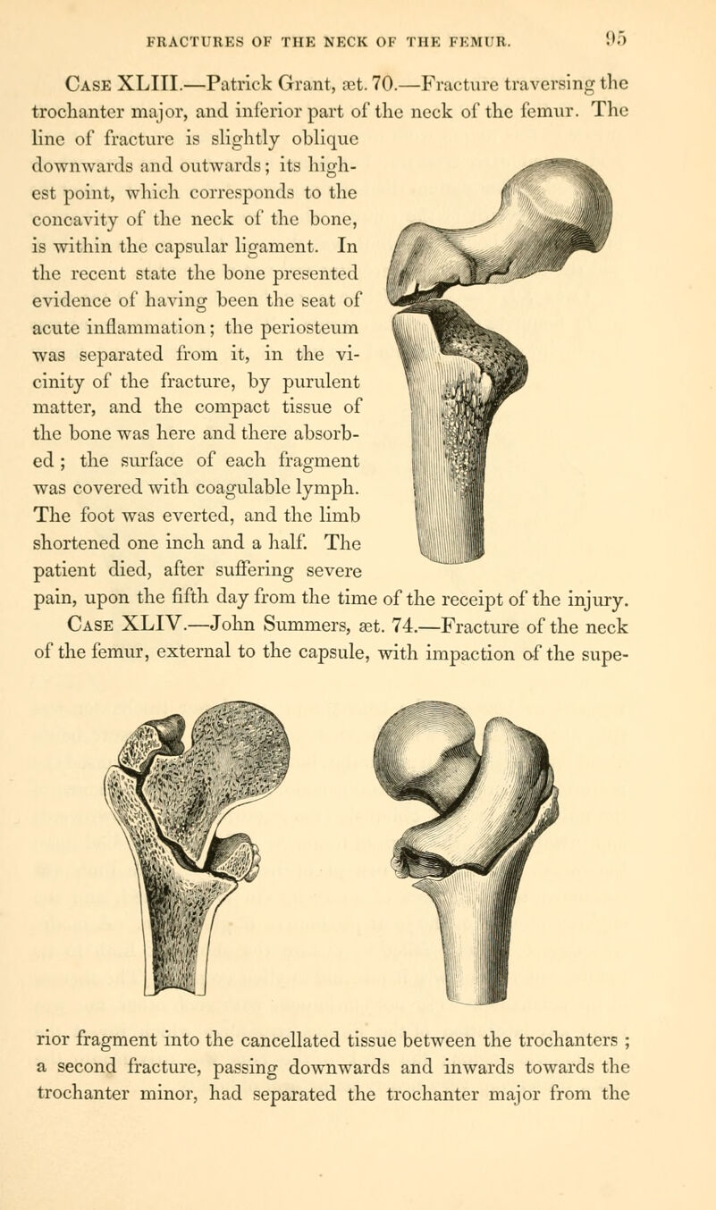 Case XLIII.—Patrick Grant, set. 70.—Fracture traversing the trochanter major, and inferior part of the neck of the femur. The line of fracture is slightly oblique downwards and outwards; its high- est point, which corresponds to the concavity of the neck of the bone, is within the capsular ligament. In the recent state the bone presented evidence of having been the seat of acute inflammation; the periosteum was separated from it, in the vi- cinity of the fracture, by purulent matter, and the compact tissue of the bone was here and there absorb- ed ; the surface of each fragment was covered with coagulable lymph. The foot was everted, and the limb shortened one inch and a half. The patient died, after suffering severe pain, upon the fifth day from the time of the receipt of the injury. Case XLIV.—John Summers, aet. 74.—Fracture of the neck of the femur, external to the capsule, with impaction of the supe- rior fragment into the cancellated tissue between the trochanters ; a second fracture, passing downwards and inwards towards the trochanter minor, had separated the trochanter major from the