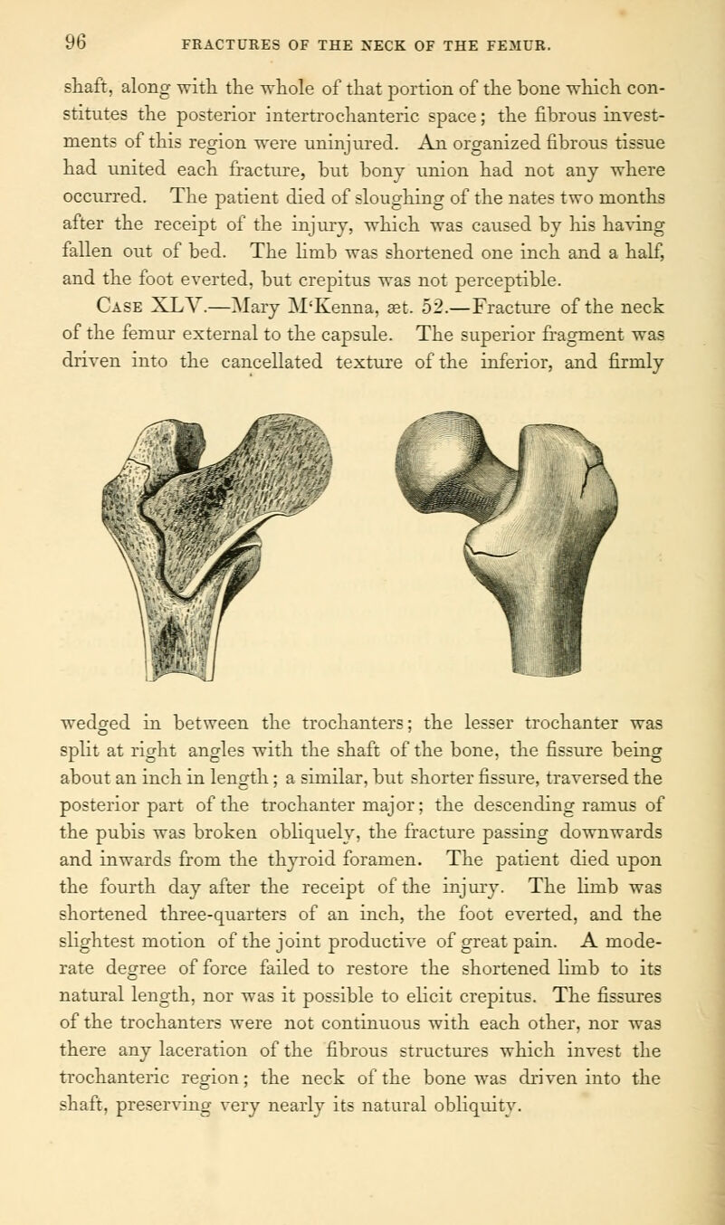 shaft, along with the whole of that portion of the bone which con- stitutes the posterior intertrochanteric space; the fibrous invest- ments of this region were uninjured. An organized fibrous tissue had united each fracture, but bony union had not any where occurred. The patient died of sloughing of the nates two months after the receipt of the injury, which was caused by his having fallen out of bed. The limb was shortened one inch and a half, and the foot everted, but crepitus was not perceptible. Case XLV.—Mary M'Kenna, set. 52.—Fracture of the neck of the femur external to the capsule. The superior fragment was driven into the cancellated texture of the inferior, and firmly wedged in between the trochanters; the lesser trochanter was split at right angles with the shaft of the bone, the fissure being about an inch in length; a similar, but shorter fissure, traversed the posterior part of the trochanter major; the descending ramus of the pubis was broken obliquely, the fracture passing downwards and inwards from the thyroid foramen. The patient died upon the fourth day after the receipt of the injury. The limb was shortened three-quarters of an inch, the foot everted, and the slightest motion of the joint productive of great pain. A mode- rate degree of force failed to restore the shortened limb to its natural length, nor was it possible to elicit crepitus. The fissures of the trochanters were not continuous with each other, nor was there any laceration of the fibrous structures which invest the trochanteric region; the neck of the bone was driven into the shaft, preserving very nearly its natural obliquity.