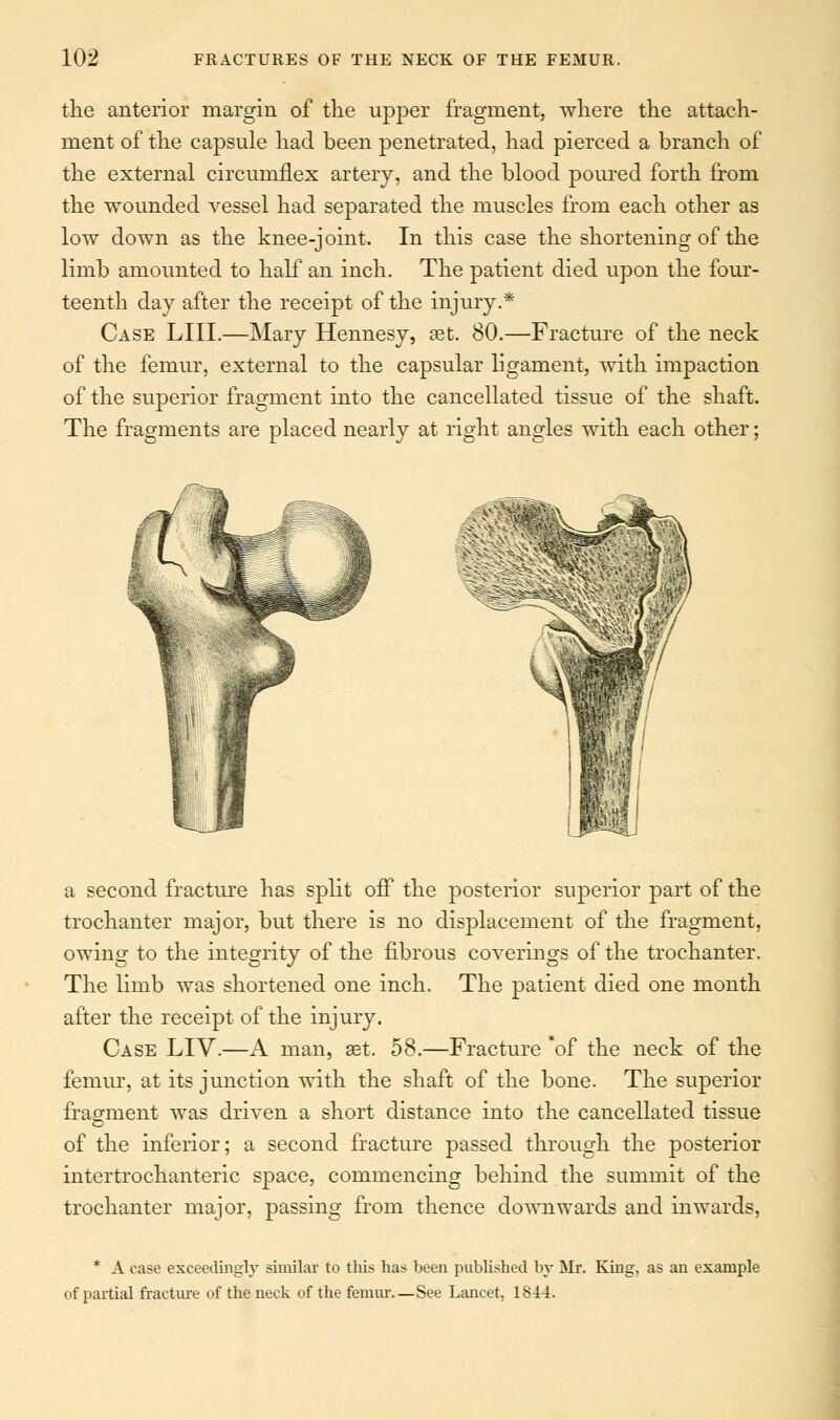 the anterior margin of the upper fragment, where the attach- ment of the capsule had been penetrated, had pierced a branch of the external circumflex artery, and the blood poured forth from the wounded vessel had separated the muscles from each other as low down as the knee-joint. In this case the shortening of the limb amounted to half an inch. The patient died upon the four- teenth day after the receipt of the injury.* Case LIII.—Mary Hennesy, aet. 80.—Fracture of the neck of the femur, external to the capsular ligament, with impaction of the superior fragment into the cancellated tissue of the shaft. The fragments are placed nearly at right angles with each other; & WEftft a second fracture has split off the posterior superior part of the trochanter major, but there is no displacement of the fragment, owing to the integrity of the fibrous coverings of the trochanter. The limb was shortened one inch. The patient died one month after the receipt of the injury. Case LIV.—A man, set. 58.—Fracture *of the neck of the femur, at its junction with the shaft of the bone. The superior fragment was driven a short distance into the cancellated tissue of the inferior; a second fracture passed through the posterior intertrochanteric space, commencing behind the summit of the trochanter major, passing from thence downwards and inwards, * A case exceedingly similar to this has been published by Mr. King, as an example of partial fracture of the neck of the femur—See Lancet, 1844.