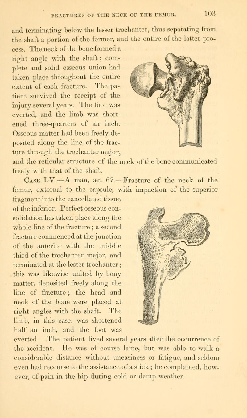 and terminating below the lesser trochanter, thus separating from the shaft a portion of the former, and the entire of the latter pro- cess. The neck of the bone formed a right angle with the shaft; com- plete and solid osseous union had taken place throughout the entire extent of each fracture. The pa- tient survived the receipt of the injury several years. The foot was everted, and the limb was short- ened three-quarters of an inch. Osseous matter had been freely de- posited along the line of the frac- ture through the trochanter major, and the reticular structure of the neck of the bone communicated freely with that of the shaft. Case LV.—A man, aat. 67.—Fracture of the neck of the femur, external to the capsule, with impaction of the superior fragment into the cancellated tissue of the inferior. Perfect osseous con- solidation has taken place along the whole line of the fracture; a second fracture commenced at the junction of the anterior with the middle third of the trochanter major, and terminated at the lesser trochanter; this was likewise united by bony matter, deposited freely along the line of fracture ; the head and neck of the bone were placed at right angles with the shaft. The limb, in this case, was shortened half an inch, and the foot was everted. The patient lived several years after the occurrence of the accident. He was of course lame, but was able to walk a considerable distance without uneasiness or fatigue, and seldom even had recourse to the assistance of a stick; he complained, how- ever, of pain in the hip during cold or damp weather.