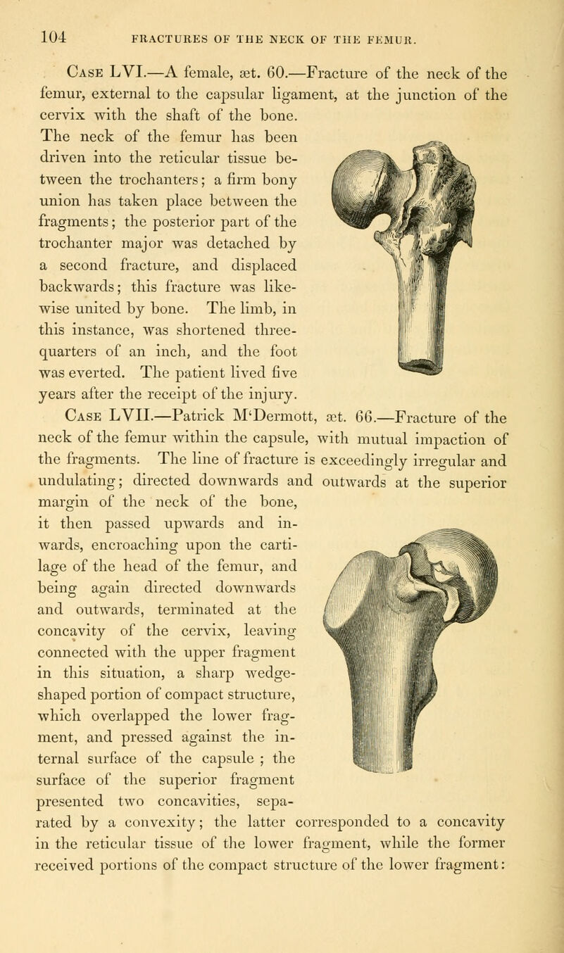 Case LVI.—A female, set. 60.—Fracture of the neck of the femur, external to the capsular ligament, at the junction of the cervix with the shaft of the bone. The neck of the femur has been driven into the reticular tissue be- tween the trochanters; a firm bony union has taken place between the fragments; the posterior part of the trochanter major was detached by a second fracture, and displaced backwards; this fracture was like- wise united by bone. The limb, in this instance, was shortened three- quarters of an inch, and the foot was everted. The patient lived five years after the receipt of the injury. Case LVIL—Patrick M'Dermott, set. 66.—Fracture of the neck of the femur within the capsule, with mutual impaction of the fragments. The line of fracture is exceedingly irregular and undulating; directed downwards and outwards at the superior margin of the neck of the bone, it then passed upwards and in- wards, encroaching upon the carti- lage of the head of the femur, and being again directed downwards and outwards, terminated at the concavity of the cervix, leaving connected with the upper fragment in this situation, a sharp wedge- shaped portion of compact structure, which overlapped the lower frag- ment, and pressed against the in- ternal surface of the capsule ; the surface of the superior fragment presented two concavities, sepa- rated by a convexity; the latter corresponded to a concavity in the reticular tissue of the lower fragment, while the former received portions of the compact structure of the lower fragment: