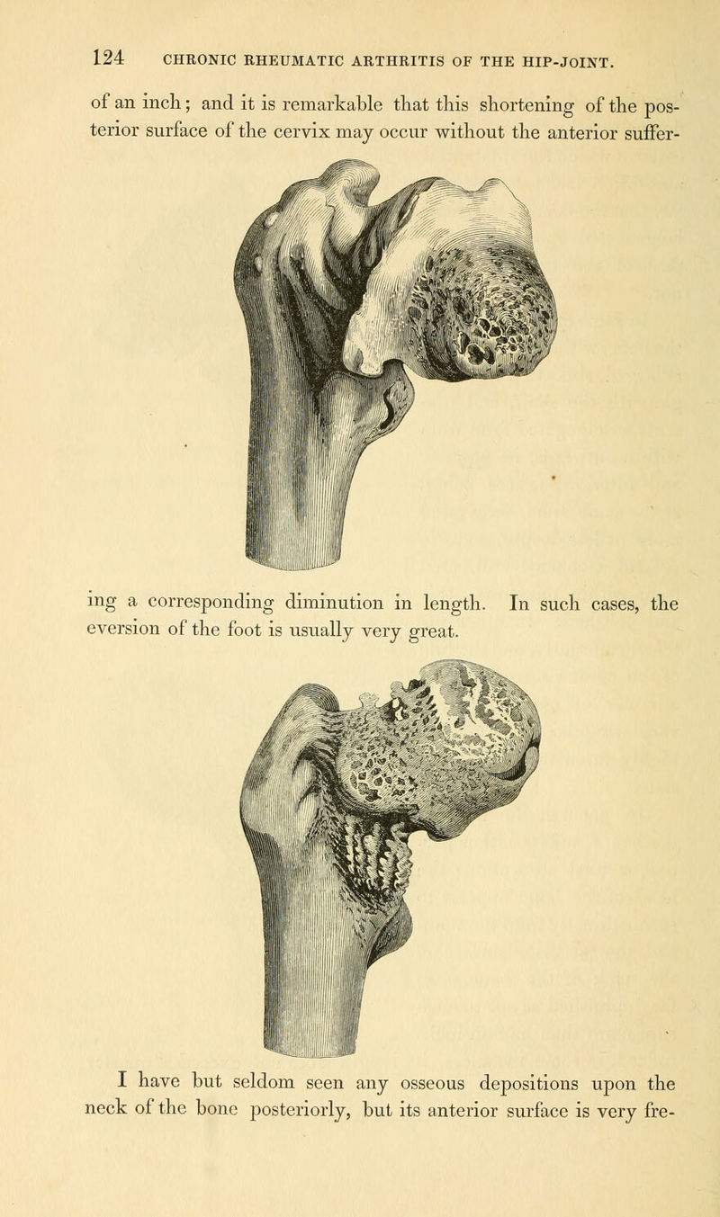 of an inch; and it is remarkable that this shortening of the pos- terior surface of the cervix may occur without the anterior suffer- ing a corresponding diminution in length. In such cases, the eversion of the foot is usually very great. I have but seldom seen any osseous depositions upon the neck of the bone posteriorly, but its anterior surface is very fre-