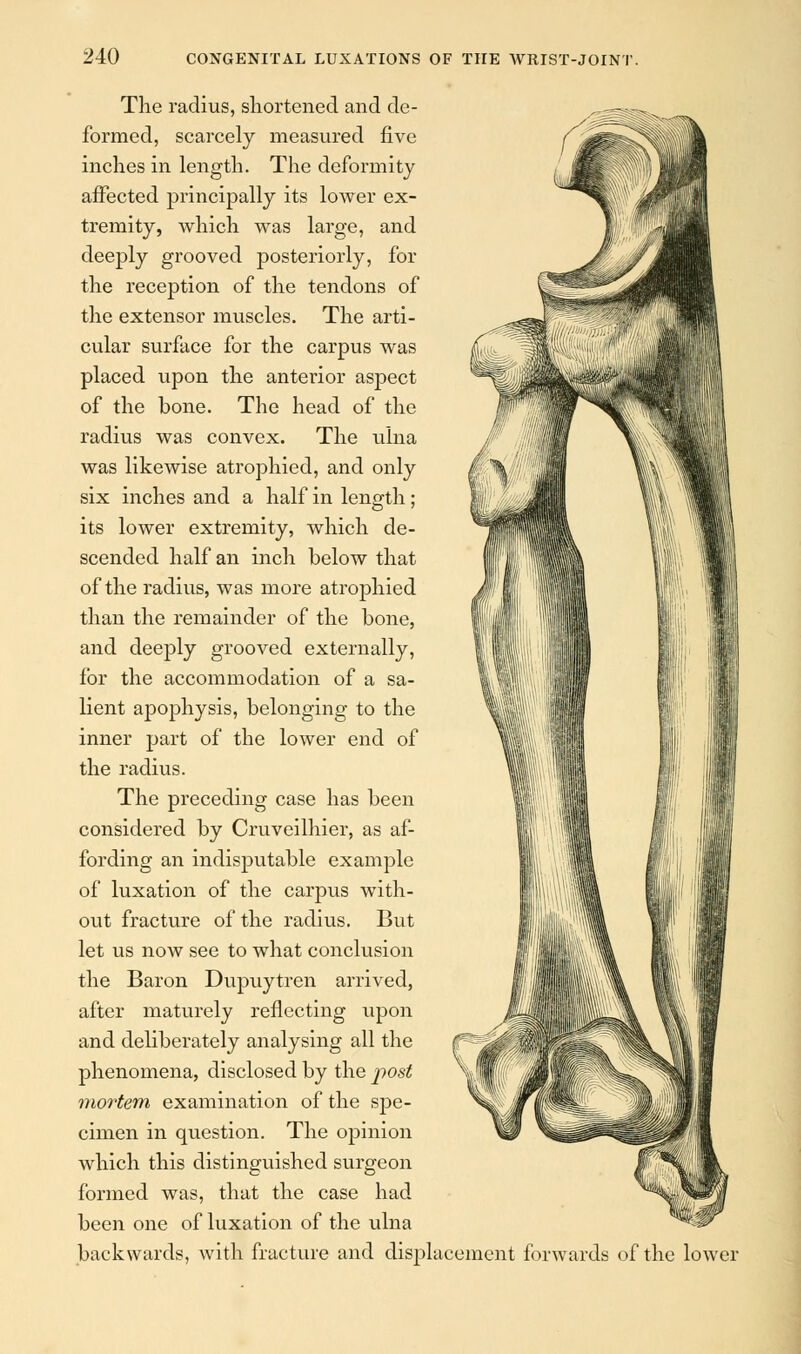 The radius, shortened and de- formed, scarcely measured five inches in length. The deformity affected principally its lower ex- tremity, which was large, and deeply grooved posteriorly, for the reception of the tendons of the extensor muscles. The arti- cular surface for the carpus was placed upon the anterior aspect of the bone. The head of the radius was convex. The ulna was likewise atrophied, and only six inches and a half in length; its lower extremity, which de- scended half an inch below that of the radius, was more atrophied than the remainder of the bone, and deeply grooved externally, for the accommodation of a sa- lient apophysis, belonging to the inner part of the lower end of the radius. The preceding case has been considered by Cruveilhier, as af- fording an indisputable example of luxation of the carpus with- out fracture of the radius. But let us now see to what conclusion the Baron Dupuytren arrived, after maturely reflecting upon and deliberately analysing all the phenomena, disclosed by the post mortem examination of the spe- cimen in question. The opinion which this distinguished surgeon formed was, that the case had been one of luxation of the ulna backwards, with fracture and displacement forwards of the lower
