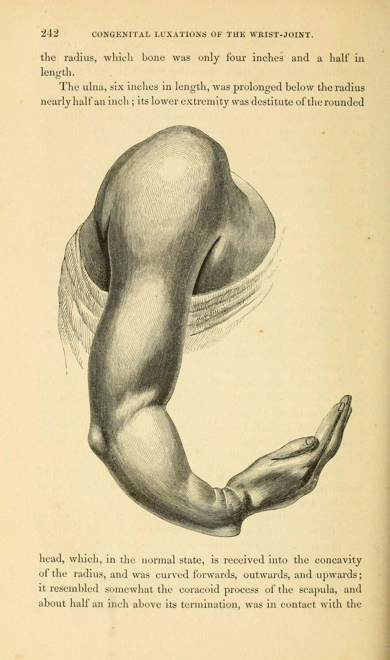 the radius, which bone was only four inches and a half in length. The ulna, six inches in length, was prolonged below the radius nearly half an inch ; its lower extremity was destitute of the rounded head, which, in the normal state, is received into the concavity of the radius, and was curved forwards, outwards, and upwards; it resembled somewhat the coracoid process of the scapula, and about half an inch above its termination, was in contact with the