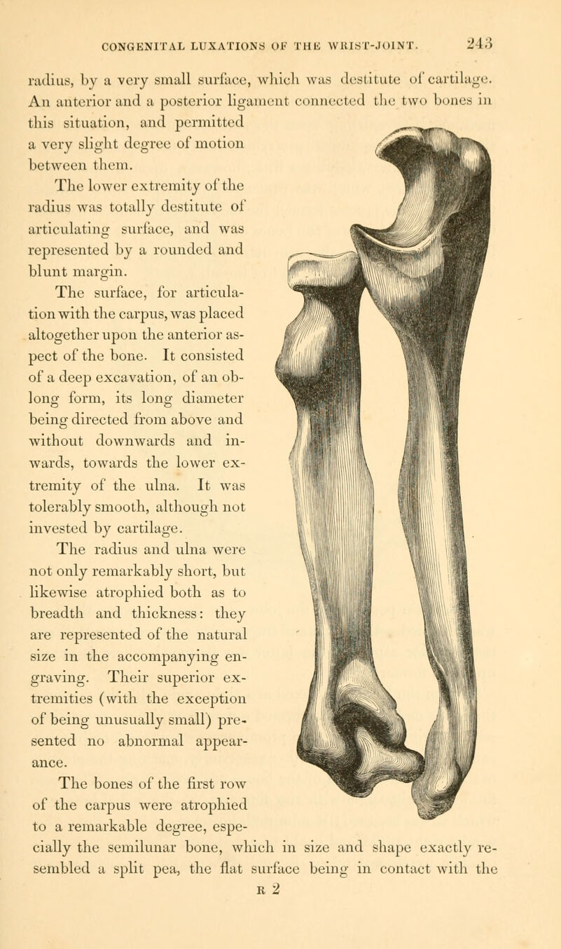 radius, by a very small surface, which was destitute of cartilage. An anterior and a posterior ligament connected the two bones in this situation, and permitted a very slight degree of motion between them. The lower extremity of the radius was totally destitute of articulating surface, and was represented by a rounded and blunt margin. The surface, for articula- tion with the carpus, was placed altogether upon the anterior as- pect of the bone. It consisted of a deep excavation, of an ob- long form, its long diameter being directed from above and without downwards and in- wards, towards the lower ex- tremity of the ulna. It was tolerably smooth, although not invested by cartilage. The radius and ulna were not only remarkably short, but likewise atrophied both as to breadth and thickness: they are represented of the natural size in the accompanying en- graving. Their superior ex- tremities (with the exception of being unusually small) pre~ sented no abnormal appear- ance. The bones of the first row of the carpus were atrophied to a remarkable degree, espe- cially the semilunar bone, which in size and shape exactly re- sembled a split pea, the flat surface being in contact with the r 2