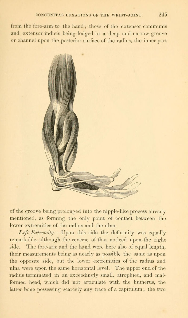 from the fore-arm to the hand; those of the extensor communis and extensor indicis being lodged in a deep and narrow groove or channel upon the posterior surface of the radius, the inner part of the groove being prolonged into the nipple-like process already mentioned, as forming the only point of contact between the lower extremities of the radius and the ulna. Left Extremity.—Upon this side the deformity was equally remarkable, although the reverse of that noticed upon the right side. The fore-arm and the hand were here also of equal length, their measurements being as nearly as possible the same as upon the opposite side, but the lower extremities of the radius and ulna wrere upon the same horizontal level. The upper end of the radius terminated in an exceedingly small, atrophied, and mal- formed head, which did not articulate with the humerus, the latter bone possessing scarcely any trace of a capitulum; the two