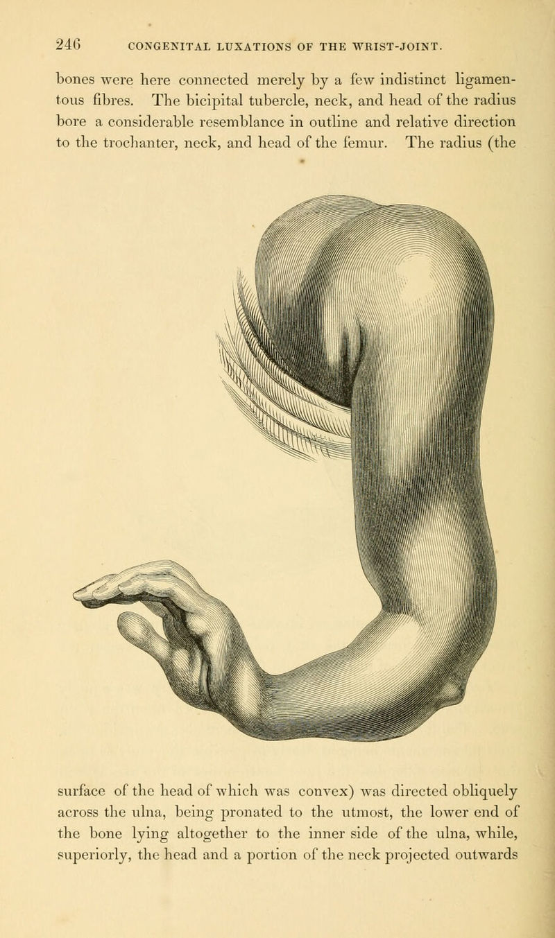 bones were here connected merely by a few indistinct ligamen- tous fibres. The bicipital tubercle, neck, and head of the radius bore a considerable resemblance in outline and relative direction to the trochanter, neck, and head of the femur. The radius (the surface of the head of which was convex) was directed obliquely across the ulna, being pronated to the utmost, the lower end of the bone lying altogether to the inner side of the ulna, while, superiorly, the head and a portion of the neck projected outwards