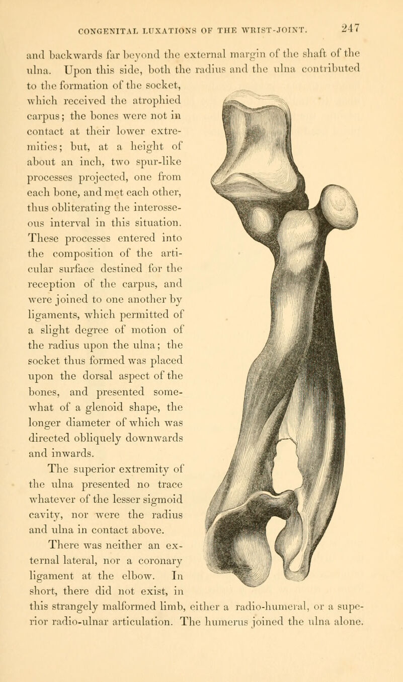 and back wards far beyond the external margin of the shaft of the ulna. Upon this side, both the radius and the ulna contributed to the formation of the socket, which received the atrophied carpus; the bones were not in contact at their lower extre- mities; but, at a height of about an inch, two spur-like processes projected, one from each bone, and met each other, thus obliterating the interosse- ous interval in this situation. These processes entered into the composition of the arti- cular surface destined for the reception of the carpus, and. were joined, to one another by ligaments, which permitted of a slight degree of motion of the radius upon the ulna; the socket thus formed was placed upon the dorsal aspect of the bones, and presented some- what of a glenoid shape, the longer diameter of which was directed obliquely downwards and inwards. The superior extremity of the ulna presented no trace whatever of the lesser sigmoid cavity, nor were the radius and ulna in contact above. There was neither an ex- ternal lateral, nor a coronary ligament at the elbow. In short, there did not exist, in this strangely malformed limb, either a radio-humeral, or a supe- rior radio-ulnar articulation. The humerus ioined the ulna alone.