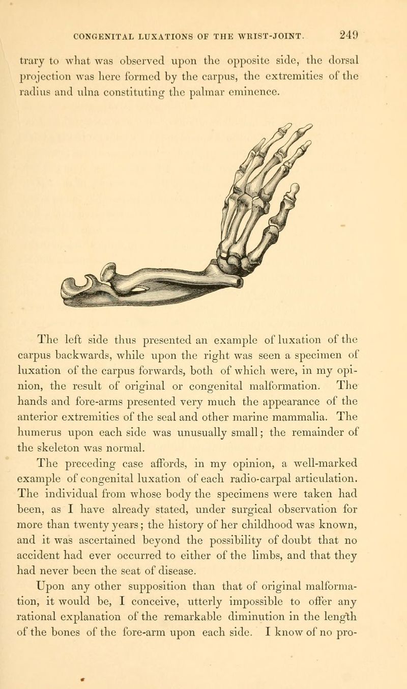 trary to what was observed upon the opposite side, the dorsal projection was here formed by the carpus, the extremities of the radius and ulna constituting the palmar eminence. The left side thus presented an example of luxation of the carpus backwards, while upon the right was seen a specimen of luxation of the carpus forwards, both of which were, in my opi- nion, the result of original or congenital malformation. The hands and fore-arms presented very much the appearance of the anterior extremities of the seal and other marine mammalia. The humerus upon each side was unusually small; the remainder of the skeleton was normal. The preceding case affords, in my opinion, a well-marked example of congenital luxation of each radio-carpal articulation. The individual from whose body the specimens were taken had been, as I have already stated, under surgical observation for more than twenty years; the history of her childhood was known, and it was ascertained beyond the possibility of doubt that no accident had ever occurred to either of the limbs, and that they had never been the seat of disease. Upon any other supposition than that of original malforma- tion, it would be, I conceive, utterly impossible to offer any rational explanation of the remarkable diminution in the length of the bones of the fore-arm upon each side. I know of no pro-