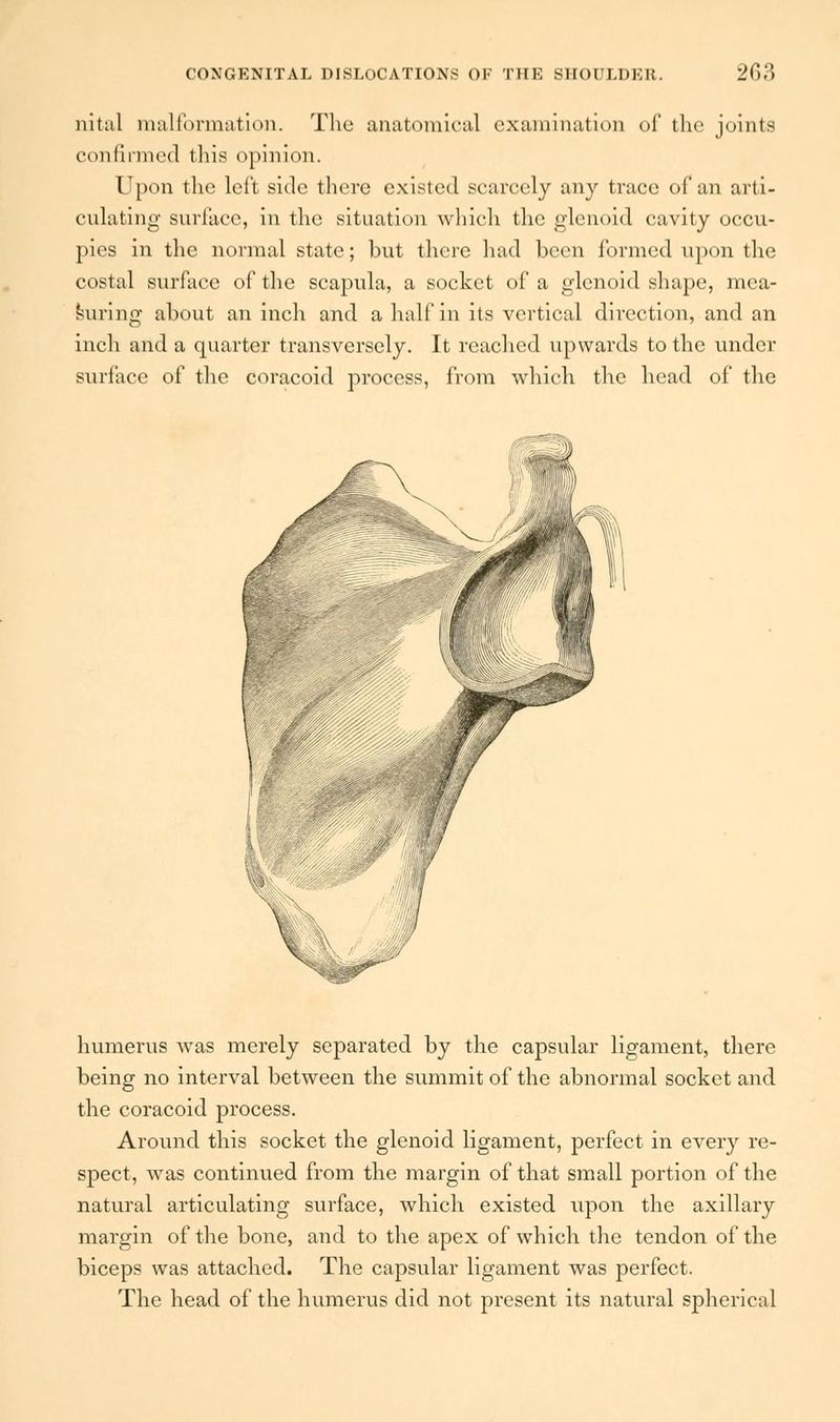 nital malformation. The anatomical examination of the joints confirmed this opinion. Upon the left side there existed scarcely any trace of an arti- culating surface, in the situation which the glenoid cavity occu- pies in the normal state; but there had been formed upon the costal surface of the scapula, a socket of a glenoid shape, mea- suring about an inch and a half in its vertical direction, and an inch and a quarter transversely. It reached upwards to the under surface of the coracoid process, from which the head of the humerus was merely separated by the capsular ligament, there being no interval between the summit of the abnormal socket and the coracoid process. Around this socket the glenoid ligament, perfect in every re- spect, was continued from the margin of that small portion of the natural articulating surface, which existed upon the axillary margin of the bone, and to the apex of which the tendon of the biceps was attached. The capsular ligament was perfect. The head of the humerus did not present its natural spherical