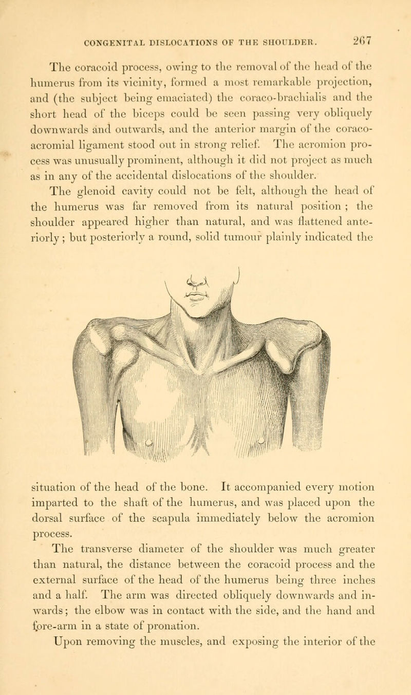 The coracoid process, owing to the removal of the bead of the humerus from its vicinity, formed a most remarkable projection, and (the subject being emaciated) the coraco-brachialis and the short head of the biceps could be seen passing very obliquely downwards and outwards, and the anterior margin of the coraeo- acromial ligament stood ont in strong relief. The acromion pro- cess was unusually prominent, although it did not project as much as in any of the accidental dislocations of the shoulder. The glenoid cavity could not be felt, although the head of the humerus was far removed from its natural position ; the shoulder appeared higher than natural, and was flattened ante- riorly ; but posteriorly a round, solid tumour plainly indicated the V„, till' * situation of the head of the bone. It accompanied every motion imparted to the shaft of the humerus, and was placed upon the dorsal surface of the scapula immediately below the acromion process. The transverse diameter of the shoulder was much greater than natural, the distance between the coracoid process and the external surface of the head of the humerus being three inches and a half. The arm was directed obliquely downwards and in- wards; the elbow was in contact with the side, and the hand and fpre-arm in a state of pronation. Upon removing the muscles, and exposing the interior of the