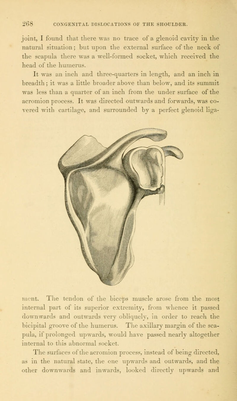 joint, I found that there was no trace of a glenoid cavity in the natural situation; but upon the external surface of the neck of the scapula there was a well-formed socket, which received the head of the humerus. It was an inch and three-quarters in length, and an inch in breadth; it was a little broader above than below, and its summit was less than a quarter of an inch from the under surface of the acromion process. It was directed outwards and forwards, was co- vered with cartilage, and surrounded by a perfect glenoid liga- ment. The tendon of the biceps muscle arose from the most internal part of its superior extremity, from whence it passed downwards and outwards very obliquely, in order to reach the bicipital groove of the humerus. The axillary margin of the sca- pula, if prolonged upwards, would have passed nearly altogether internal to this abnormal socket. The surfaces of the acromion process, instead of being directed, as in the natural state, the one upwards and outwards, and the other downwards and inwards, looked directly upwards and