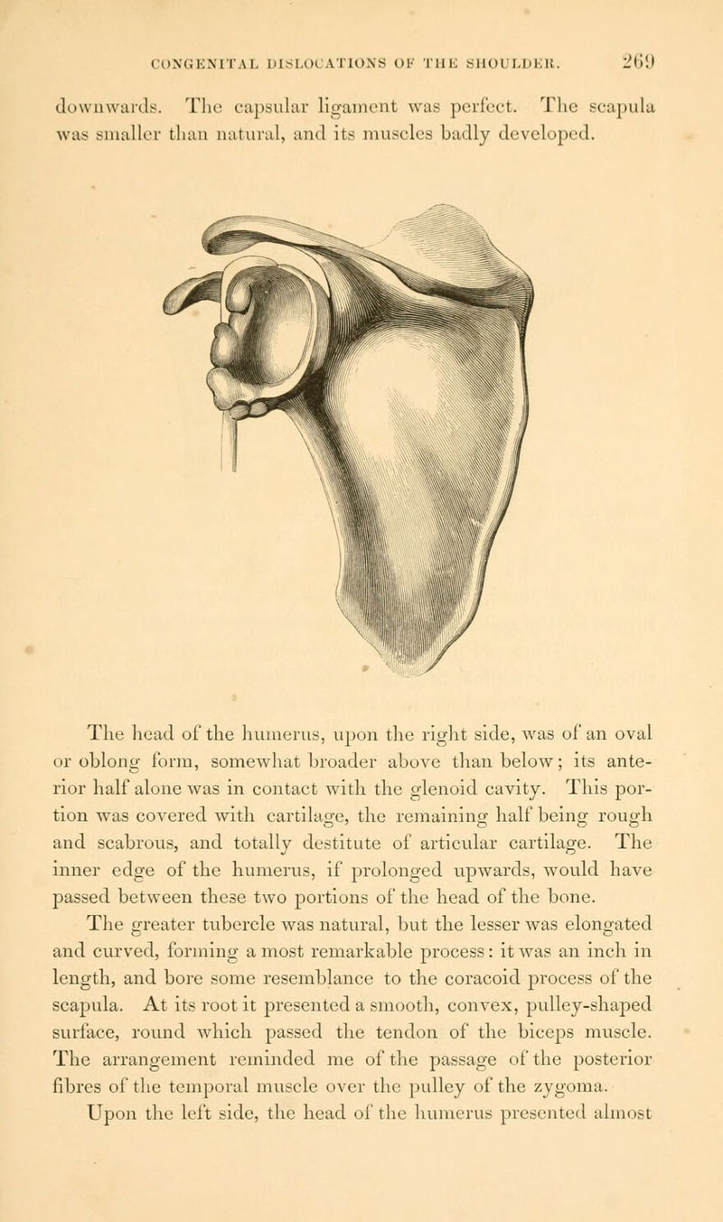 downwards. The capsular ligament was perfect. The scapula was smaller than natural, and its muscles badly developed. The head of the humerus, upon the right side, was of an oval or oblong form, somewhat broader above than below; its ante- rior half alone was in contact with the glenoid cavity. This por- tion was covered with cartilage, the remaining half being rough and scabrous, and totally destitute of articular cartilage. The inner edge of the humerus, if prolonged upwards, would have passed between these two portions of the head of the bone. The greater tubercle was natural, but the lesser was elongated and curved, forming a most remarkable process: it was an inch in length, and bore some resemblance to the coracoid process of the scapula. At its root it presented a smooth, convex, pulley-shaped surface, round which passed the tendon of the biceps muscle. The arrangement reminded me of the passage of the posterior fibres of the temporal muscle over the pulley of the zygoma. Upon the left side, the head of the humerus presented almost