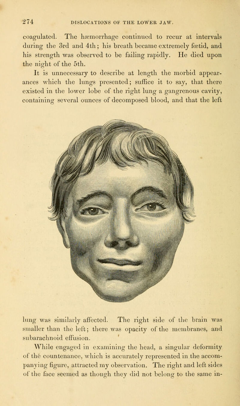 coagulated. The haemorrhage continued to recur at intervals during the 3rd and 4th; his breath became extremely foetid, and his strength was observed to be failing rapidly. He died upon the nig-ht of the 5th. It is unnecessary to describe at length the morbid appear- ances which the lungs presented; suffice it to say, that there existed in the lower lobe of the right lung a gangrenous cavity, containing several ounces of decomposed blood, and that the left lung was similarly affected. The right side of the brain was smaller than the left; there was opacity of the membranes, and subarachnoid effusion. While engaged in examining the head, a singular deformity of the countenance, which is accurately represented in the accom- panying figure, attracted my observation. The right and left sides of the face seemed as though they did not belong to the same in-