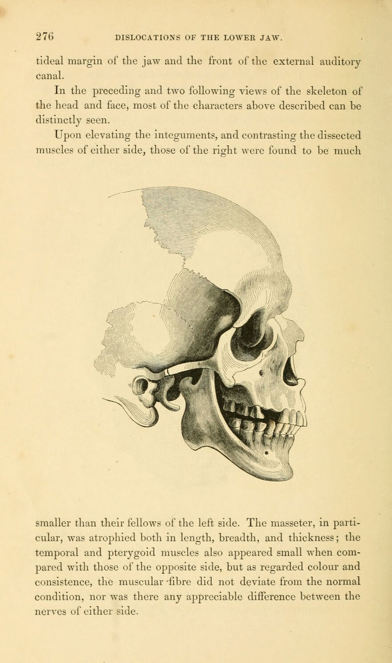 tideal margin of the jaw and the front of the external auditory canal. In the preceding and twro following views of the skeleton of the head and face, most of the characters above described can be distinctly seen. Upon elevating the integuments, and contrasting the dissected muscles of either side, those of the right were found to be much smaller than their fellows of the left side. The masseter, in parti- cular, was atrophied both in length, breadth, and thickness; the temporal and pterygoid muscles also appeared small when com- pared with those of the opposite side, but as regarded colour and consistence, the muscular -fibre did not deviate from the normal condition, nor was there any appreciable difference between the nerves of either side.