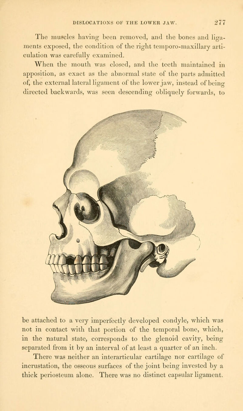 The muscles having been removed, and the bones and liga- ments exposed, the condition of the right temporo-maxillary arti- culation was carefully examined. When the mouth was closed, and the teeth maintained in apposition, as exact as the abnormal state of the parts admitted of, the external lateral ligament of the lower jaw, instead of being directed backwards, was seen descending obliquely forwards, to be attached to a very imperfectly developed condyle, which was not in contact with that portion of the temporal bone, which, in the natural state, corresponds to the glenoid cavity, being separated from it by an interval of at least a quarter of an inch. There was neither an interarticular cartilage nor cartilage of incrustation, the osseous surfaces of the joint being invested by a thick periosteum alone. There was no distinct capsular ligament.