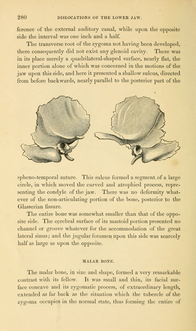 ference of the external auditory canal, while upon the opposite side the interval was one inch and a half. The transverse root of the zygoma not having been developed, there consequently did not exist any glenoid cavity. There was in its place merely a quadrilateral-shaped surface, nearly flat, the inner portion alone of which was concerned in the motions of the jaw upon this side, and here it presented a shallow sulcus, directed from before backwards, nearly parallel to the posterior part of the spheno-temporal suture. This sulcus formed a segment of a large circle, in which moved the curved and atrophied process, repre- senting the condyle of the jaw. There was no deformity what- ever of the non-articulating portion of the bone, posterior to the Glasserian fissure. The entire bone was somewhat smaller than that of the oppo- site side. The cerebral surface of its mastoid portion presented no channel or groove whatever for the accommodation of the great lateral sinus; and the jugular foramen upon this side was scarcely half as large as upon the opposite. MALAR BONE. The malar bone, in size and shape, formed a very remarkable contrast with its fellow. It was small and thin, its facial sur- face concave and its zygomatic process, of extraordinary length, extended as far back as the situation which the tubercle of the zygoma occupies in the normal state, thus forming the entire of