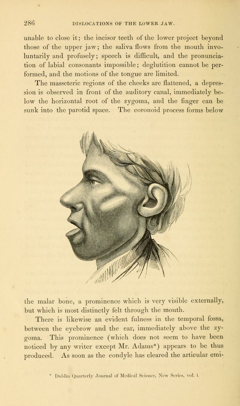 unable to close it; the incisor teeth of the lower project beyond those of the upper jaw; the saliva flows from the mouth invo- luntarily and profusely; speech is difficult, and the pronuncia- tion of labial consonants impossible; deglutition cannot be per- formed, and the motions of the tongue are limited. The masseteric regions of the cheeks are flattened, a depres- sion is observed in front of the auditory canal, immediately be- low the horizontal root of the zygoma, and the finger can be sunk into the parotid space. The coronoid process forms below the malar bone, a prominence which is very visible externally, but which is most distinctly felt through the mouth. There is likewise an evident fulness in the temporal fossa, between the eyebrow and the ear, immediately above the zy- goma. This prominence (which does not seem to have been noticed by any writer except Mr. Adams*) appears to be thus produced. As soon as the condyle has cleared the articular emi- * Dublin Quarterly Journal of Medical Science. New Series, vol. i
