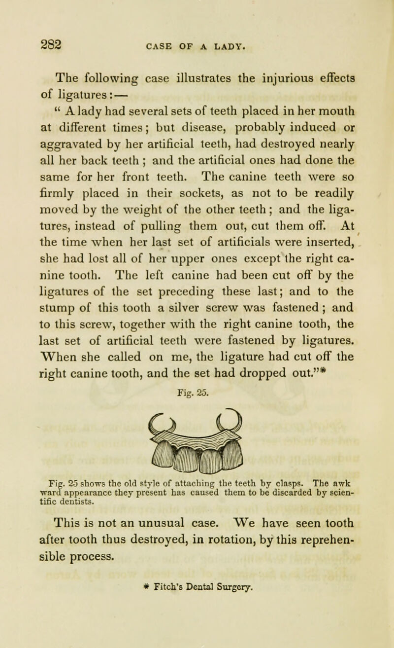 The following case illustrates the injurious effects of ligatures: —  A lady had several sets of teeth placed in her mouth at different times; but disease, probably induced or aggravated by her artificial teeth, had destroyed nearly all her back teeth ; and the artificial ones had done the same for her front teeth. The canine teeth were so firmly placed in their sockets, as not to be readily moved by the weight of the other teeth ; and the liga- tures, instead of pulling them out, cut ihem off. At the time when her last set of artificials were inserted, she had lost all of her upper ones except the right ca- nine tooth. The left canine had been cut off by the ligatures of the set preceding these last; and to the stump of this tooth a silver screw was fastened ; and to this screw, together with the right canine tooth, the last set of artificial teeth were fastened by ligatures. When she called on me, the ligature had cut off the right canine tooth, and the set had dropped out.* Fig. 25. Fig. 25 shows the old style of attaching the teeth by clasps. The awk ward appearance they present has caused them to be discarded by scien- tific dentists. This is not an unusual case. We have seen tooth after tooth thus destroyed, in rotation, by this reprehen- sible process. * Fitch's Dental Surgery.