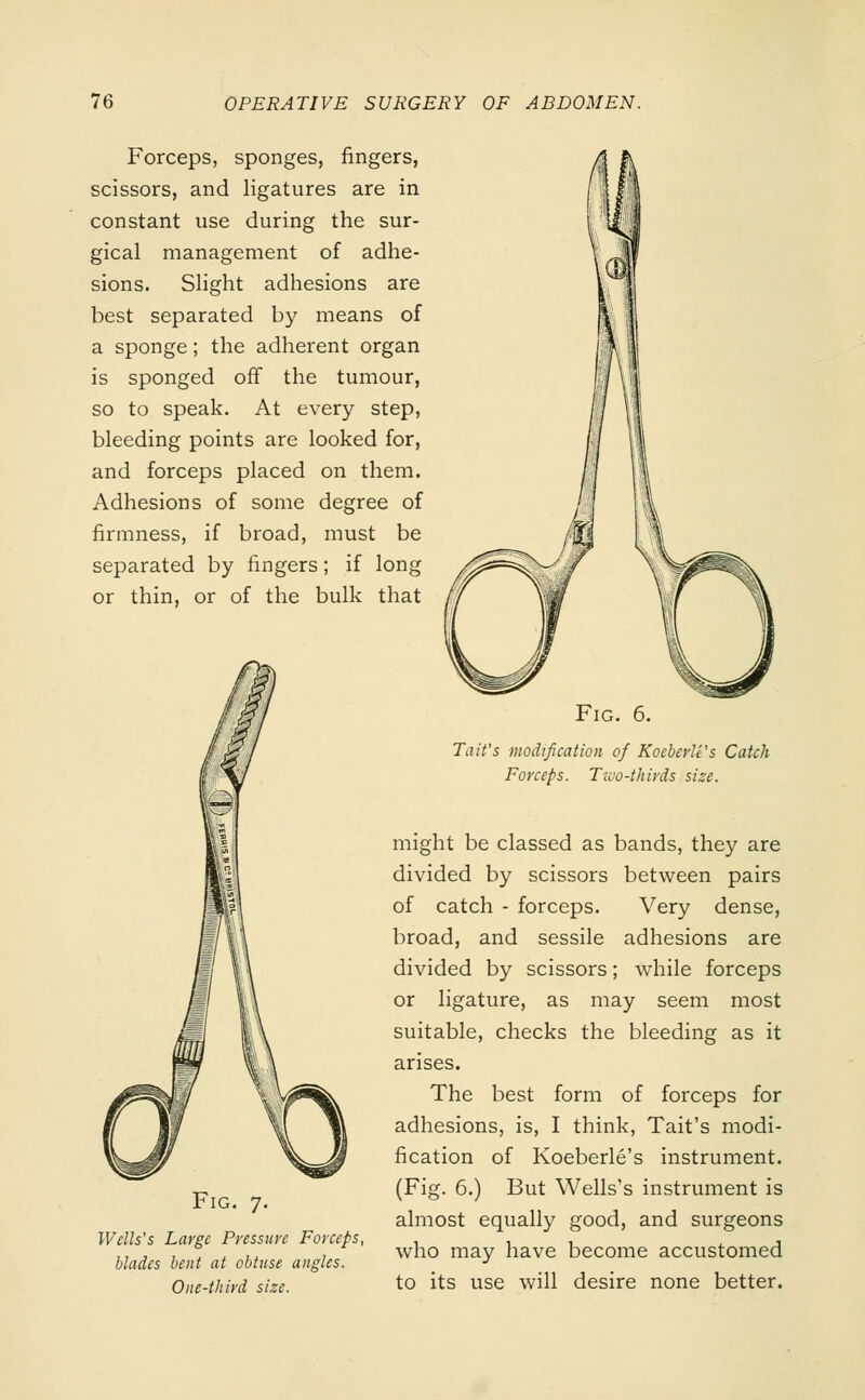 Forceps, sponges, ringers, scissors, and ligatures are in constant use during the sur- gical management of adhe- sions. Slight adhesions are best separated by means of a sponge; the adherent organ is sponged off the tumour, so to speak. At every step, bleeding points are looked for, and forceps placed on them. Adhesions of some degree of firmness, if broad, must be separated by fingers; if long or thin, or of the bulk that Fig. 7. Wells's Large Pressure Forceps, blades bent at obtuse angles. One-third size. Fig. 6. Tait's modification of Koeberle's Catch Forceps. Two-thirds size. might be classed as bands, they are divided by scissors between pairs of catch - forceps. Very dense, broad, and sessile adhesions are divided by scissors; while forceps or ligature, as may seem most suitable, checks the bleeding as it arises. The best form of forceps for adhesions, is, I think, Tait's modi- fication of Koeberle's instrument. (Fig. 6.) But Wells's instrument is almost equally good, and surgeons who may have become accustomed to its use will desire none better.