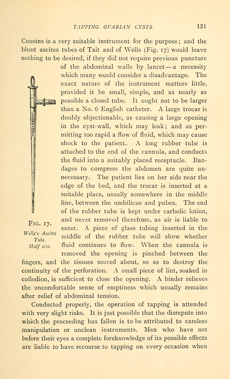 Cousins is a very suitable instrument for the purpose; and the blunt ascites tubes of Tait and of Wells (Fig. 17) would leave nothing to be desired, if they did not require previous puncture of the abdominal walls by lancet — a necessity which many would consider a disadvantage. The exact nature of the instrument matters little, provided it be small, simple, and as nearly as possible a closed tube. It ought not to be larger than a No. 6 English catheter. A large trocar is doubly objectionable, as causing a large opening in the cyst-wall, which may leak; and as per- mitting too rapid a flow of fluid, which may cause shock to the patient. A long rubber tube is attached to the end of the cannula, and conducts the fluid into a suitably placed receptacle. Ban- dages to compress the abdomen are quite un- necessary. The patient lies on her side near the edge of the bed, and the trocar is inserted at a suitable place, usually somewhere in the middle line, between the umbilicus and pubes. The end of the rubber tube is kept under carbolic lotion, and never removed therefrom, as air is liable to enter. A piece of glass tubing inserted in the middle of the rubber tube will show whether fluid continues to flow. When the cannula is removed the opening is pinched between the fingers, and the tissues moved about, so as to destroy the continuity of the perforation. A small piece of lint, soaked in collodion, is sufficient to close the opening. A binder relieves the uncomfortable sense of emptiness which usually remains after relief of abdominal tension. Conducted properly, the operation of tapping is attended with very slight risks. It is just possible that the disrepute into which the proceeding has fallen is to be attributed to careless manipulation or unclean instruments. Men who have not before their eyes a complete foreknowledge of its possible effects are liable to have recourse to tapping on every occasion when Fig. 17. Wells's Ascites Tube. Half size.