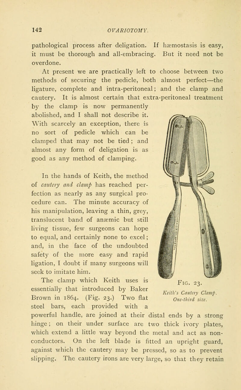 pathological process after deligation. If haemostasis is easy, it must be thorough and all-embracing. But it need not be overdone. At present we are practically left to choose between two methods of securing the pedicle, both almost perfect—the ligature, complete and intra-peritoneal; and the clamp and cautery. It is almost certain that extra-peritoneal treatment by the clamp is now permanently abolished, and I shall not describe it. With scarcely an exception, there is no sort of pedicle which can be clamped that may not be tied ; and almost any form of deligation is as good as any method of clamping. In the hands of Keith, the method of cautery and clamp has reached per- fection as nearly as any surgical pro- cedure can. The minute accuracy of his manipulation, leaving a thin, grey, translucent band of anaemic but still living tissue, few surgeons can hope to equal, and certainly none to excel; and, in the face of the undoubted safety of the more easy and rapid ligation, I doubt if many surgeons will seek to imitate him. The clamp which Keith uses is essentially that introduced by Baker Brown in 1864. (Fig. 23.) Two flat steel bars, each provided with a powerful handle, are joined at their distal ends by a strong hinge; on their under surface are two thick ivory plates, which extend a little way beyond the metal and act as non- conductors. On the left blade is fitted an upright guard, against which the cautery may be pressed, so as to prevent slipping. The cautery irons are very large, so that they retain Fig. 23. Keith's Cautery Clamp. One-third size.