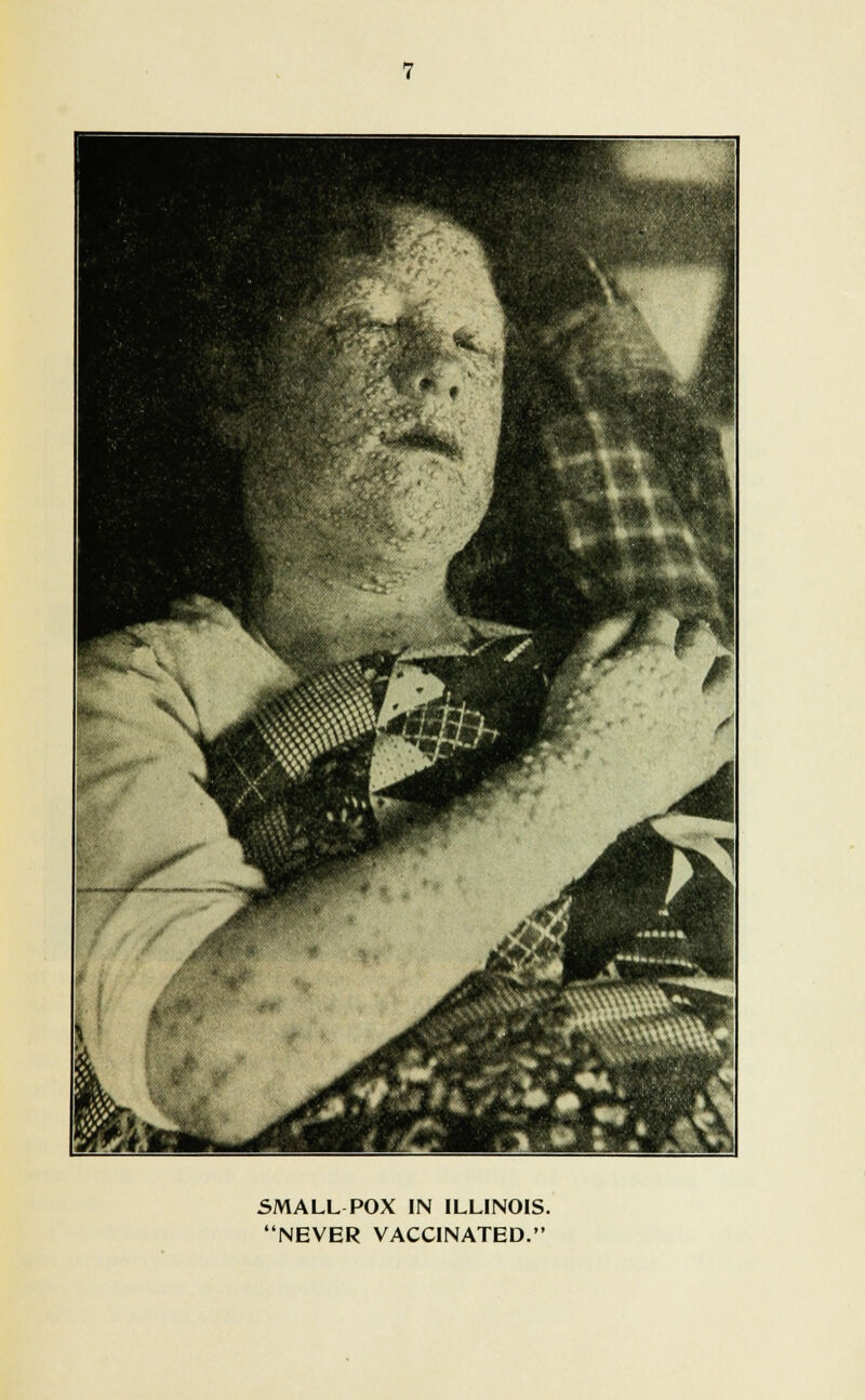 SMALL POX IN ILLINOIS.