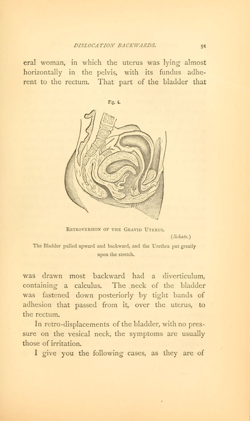 eral woman, in which the uterus was lying almost horizontally in the pelvis, with its fundus adhe- rent to the rectum. That part of the bladder that Fig. 4. Retroversion of the Gravid Uterus. (Schatz.) The Bladder pulled upward and backward, and the Urethra put greatly upon the stretch. was drawn most backward had a diverticulum, containing a calculus. The neck of the bladder was fastened down posteriorly by tight bands of adhesion that passed from it, over the uterus, to the rectum. In retro-displacements of the bladder, with no pres- sure on the vesical neck, the symptoms are usually those of irritation. I give you the following cases, as they are of