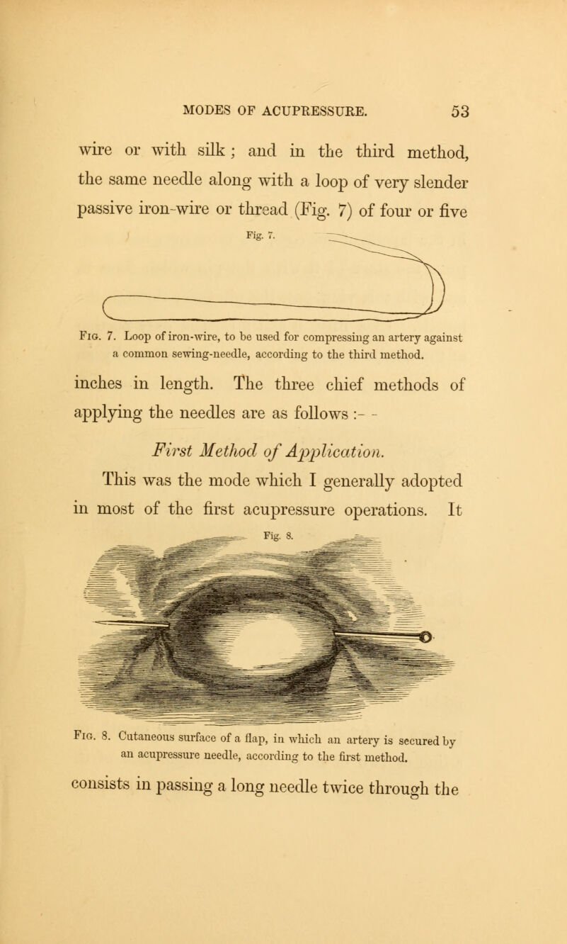 wire or with silk; and in the third method, the same needle along with a loop of very slender passive iron-wire or thread (Fig. 7) of four or five Fig. 7. Fig. 7. Loop of iron-wire, to be used for compressing an artery against a common sewing-needle, according to the third method. inches in length. The three chief methods of applying the needles are as follows :- - First Method of Application. This was the mode which I generally adopted in most of the first acupressure operations. It Fig. 8. Fig. 8. Cutaneous surface of a flap, in which an artery is secured by an acupressure needle, according to the first method. consists in passing a long needle twice through the