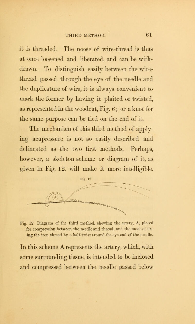 it is threaded. The noose of wire-thread is thus at once loosened and liberated, and can be with- drawn. To distinguish easily between the wire- thread passed through the eye of the needle and the duplicature of wire, it is always convenient to mark the former by having it plaited or twisted, as represented in the woodcut, Fig. 6; or a knot for the same purpose can be tied on the end of it. The mechanism of this third method of apply- ing acupressure is not so easily described and delineated as the two first methods. Perhaps, however, a skeleton scheme or diagram of it, as given in Fig. 12, will make it more intelligible. Fig. 12. Fig. 12. Diagram of the third method, shewing the artery, A, placed for compression between the needle and thread, and the mode of fix- ing the iron thread by a half-twist around the eye-end of the needle. In this scheme A represents the artery, which, with some surrounding tissue, is intended to be inclosed and compressed between the needle passed below