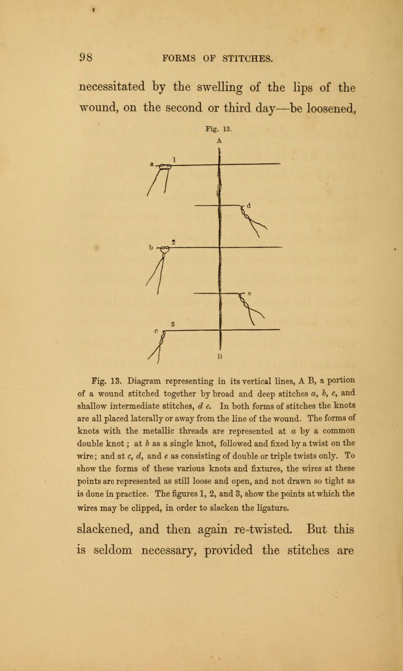 necessitated by the swelling of the lips of the wound, on the second or third day—be loosened, Fig. 13. A Fig. 13. Diagram representing in its vertical lines, A B, a portion of a wound stitched together by broad and deep stitches a, b, c, and shallow intermediate stitches, d e. In both forms of stitches the knots are all placed laterally or away from the line of the wound. The forms of knots with the metallic threads are represented at a by a common double knot; at & as a single knot, followed and fixed by a twist on the wire; and at c, d, and e as consisting of double or triple twists only. To show the forms of these various knots and fixtures, the wires at these points are represented as still loose and open, and not drawn so tight as is done in practice. The figures 1, 2, and 3, show the points at which the wires may be clipped, in order to slacken the ligature. slackened, and then again re-twisted. But this is seldom necessary, provided the stitches are