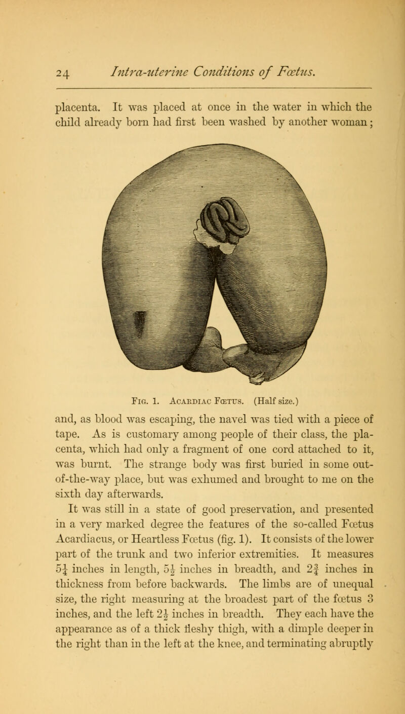 placenta. It was placed at once in the water in which the child already born had first been washed by another woman; Fig. 1. Acardiac Fcetus. (Half size.) and, as blood was escaping, the navel was tied with a piece of tape. As is customary among people of their class, the pla- centa, which had only a fragment of one cord attached to it, was burnt. The strange body was first buried in some out- of-the-way place, but was exhumed and brought to me on the sixth day afterwards. It was still in a state of good preservation, and presented in a very marked degree the features of the so-called Fcetus Acardiacus, or Heartless Fcetus (fig. 1). It consists of the lower part of the trunk and two inferior extremities. It measures 5\ inches in length, 5 \ inches in breadth, and 2| inches in thickness from before backwards. The limbs are of unequal size, the right measuring at the broadest part of the foetus 3 inches, and the left 2 \ inches in breadth. They each have the appearance as of a thick tleshy thigh, with a dimple deeper in the right than in the left at the knee, and terminating abruptly