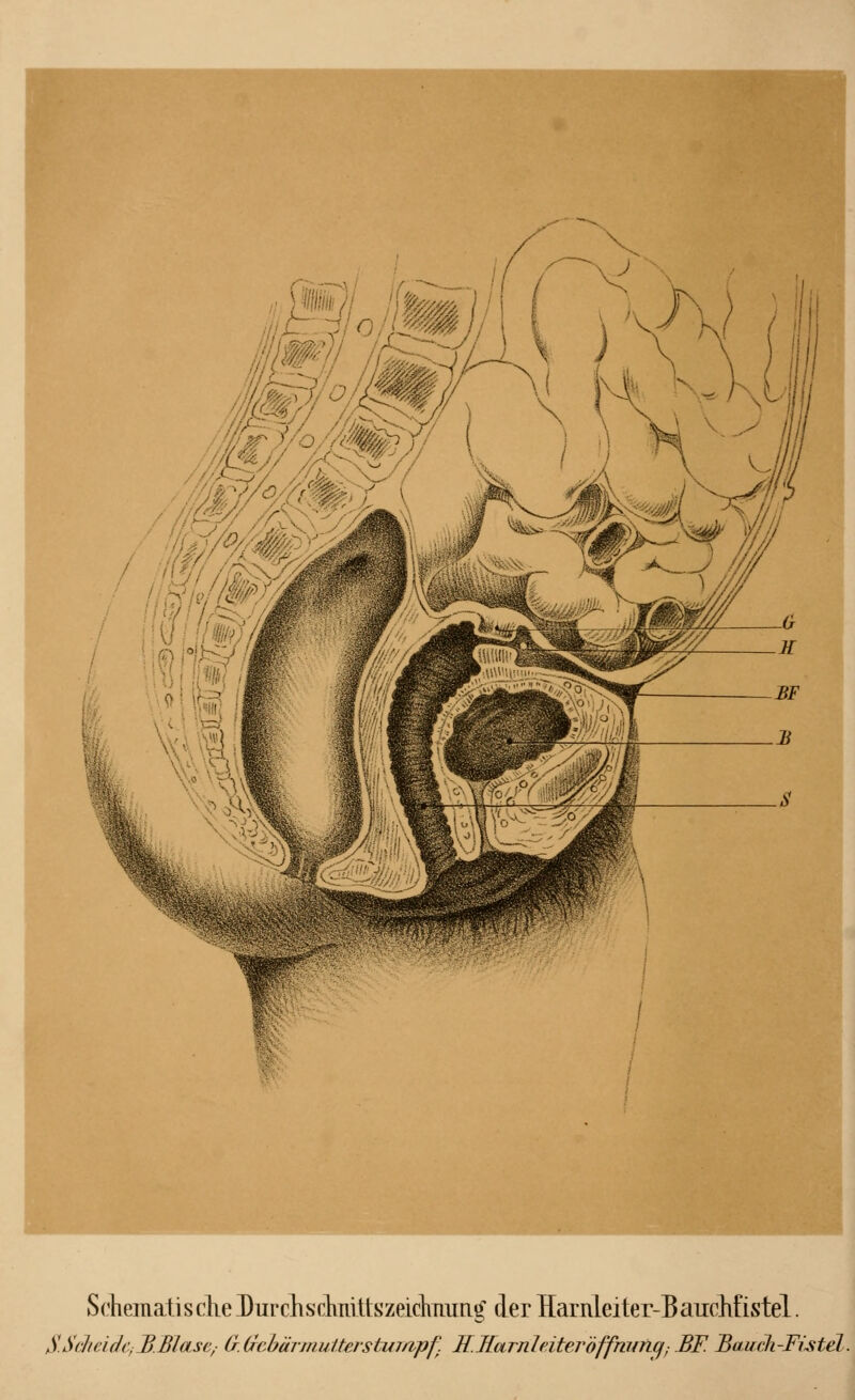 Schematische ^urchschnUtszeichming' der Harnleiter-Bauchfistel. S.ScheidCfBJSldsef (r.6feiärmutterstumpf. I£.Harnleiteröffmmqr BF. Bauch-Fistel.