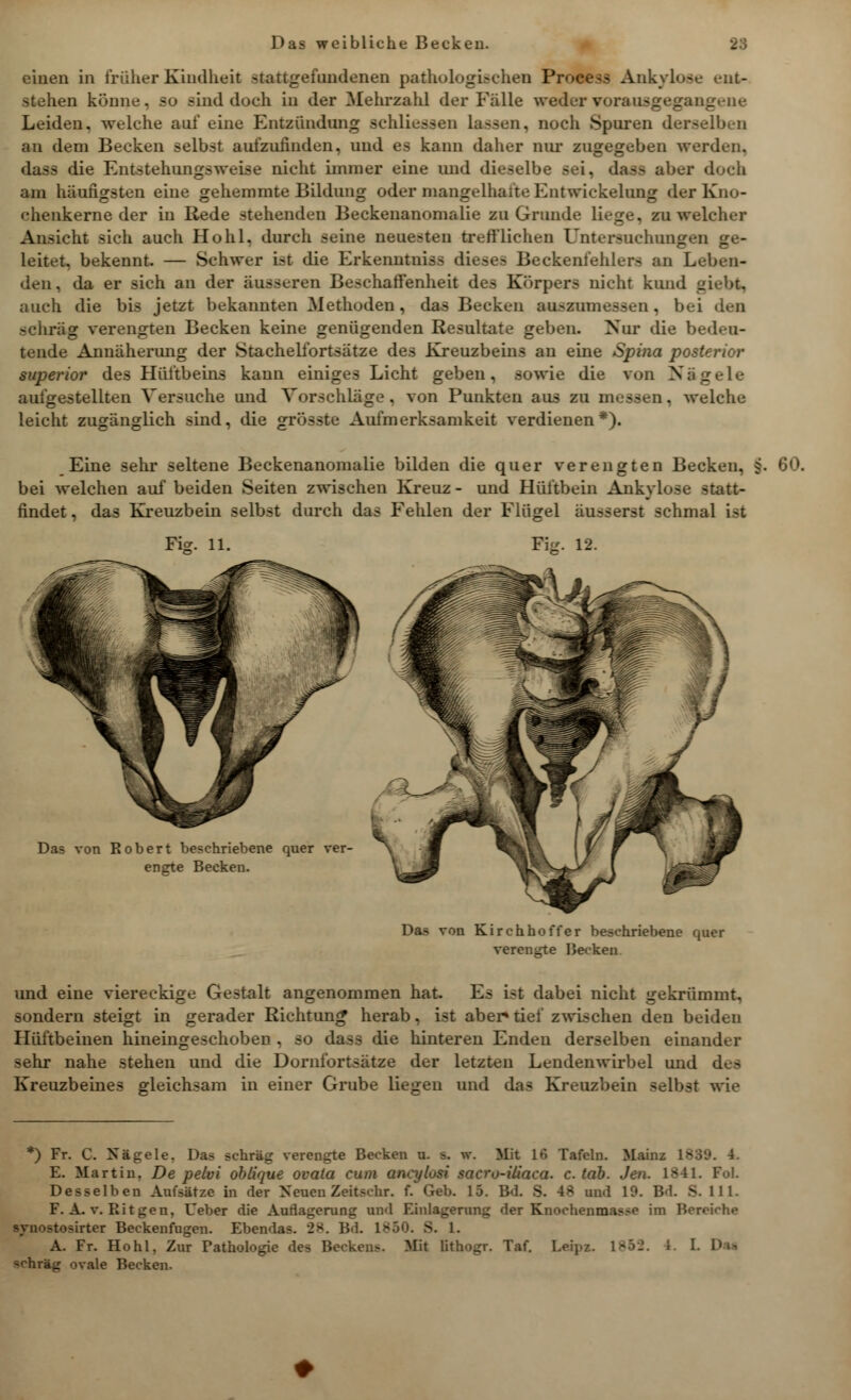 einen in froher Kindheit stattgefundenen pathologischen Pi ut- stehen könne, so sind doch in der Mehrzahl der Fälle weder voraus ine Leiden, welche auf eine Entzündung schliefen lassen, noch Spuren derselben an dem Becken selbst aufzufinden, und es kann dalier nur zugegeben werden, dass die Entstehungsweise nicht immer eine und dieselbe sei, dasa aber doch am häufigsten eine gehemmte Bildung oder mangelhalte Entwiekelnng dar Kno- chenkerne der in Rede stehenden Beckenanomalie zu Grunde liege, snwelcher Ansicht sich auch Hohl, durch seine neuesten trefflichen Untersuchungen ge- leitet, bekennt. — Schwer ist die Erkenutniss dieses Beckenfehlera an Leben- den, da er sich an der äusseren Beschaffenheit des Körpers nicht kund giebt, auch die bis jetzt bekannten Methoden, das Becken auszumessen. bei den schräg verengten Becken keine genügenden Resultate geben. Nur die bedeu- tende Annäherung der Stachelfortsätze des Kreuzbeins an eine Spina posterior superior des Hüftbeins kann einiges Licht geben, sowie die von Nägele aufgestellten Versuche und Vorschläge, von Punkten aus zu messen, welche leicht zugänglich sind, die grösste Aufmerksamkeit verdienen*). Eine sehr seltene Beckenanomalie bilden die quer verengten Becken, §. 60. bei welchen auf beiden Seiten zwischen Kreuz - und Hüftbein Ankylose statt- findet, das Kreuzbein selbst durch das Fehlen der Flügel äusserst schmal i-t Fior 11. pfe Das von Robert beschriebene quer ver engte Beeken. Das von Kirchhoff er beschriebene quer verengte Hecken. und eine viereckige Gestalt angenommen hat. Es ist dabei nicht gekrümmt, sondern steigt in gerader Richtung herab, ist aber*tief zwischen den beiden Hüftbeinen hineingeschoben, so dass die hinteren Enden derselben einander sehr nahe stehen und die Dornfortsätze der letzten Lendenwirbel und des Kreuzbeines gleichsam in einer Grube liegen und das Kreuzbein selbst wie *) Fr. C. Nägele. Das schräg verengte Becken u. s. w. Mit 16 Tafeln. Mainz 1839. 4. E. Martin. De pelvi oblique ovata cum ancylvsi sacro-iüaea. c. tab. Jen. 1S41. Fol. Desselben Aufsätze in der Neuen Zeitschr. f. Geb. 15. Bd. S. 4* und 19. Bd. 8. HL F. A. v. Bit gen, Ueber die Auflagerung und Einlagerung der Knoehenausse im Bereiche Bynostosirter Beckenfugen. Ebendas. 28. Bd Lfi 3. 1. A. Fr. Hohl, Zur Pathologie des Beckens. Mit Bthogr. Taf. Leios. 1852. L. 1. D«i -^hräg ovale Becken.