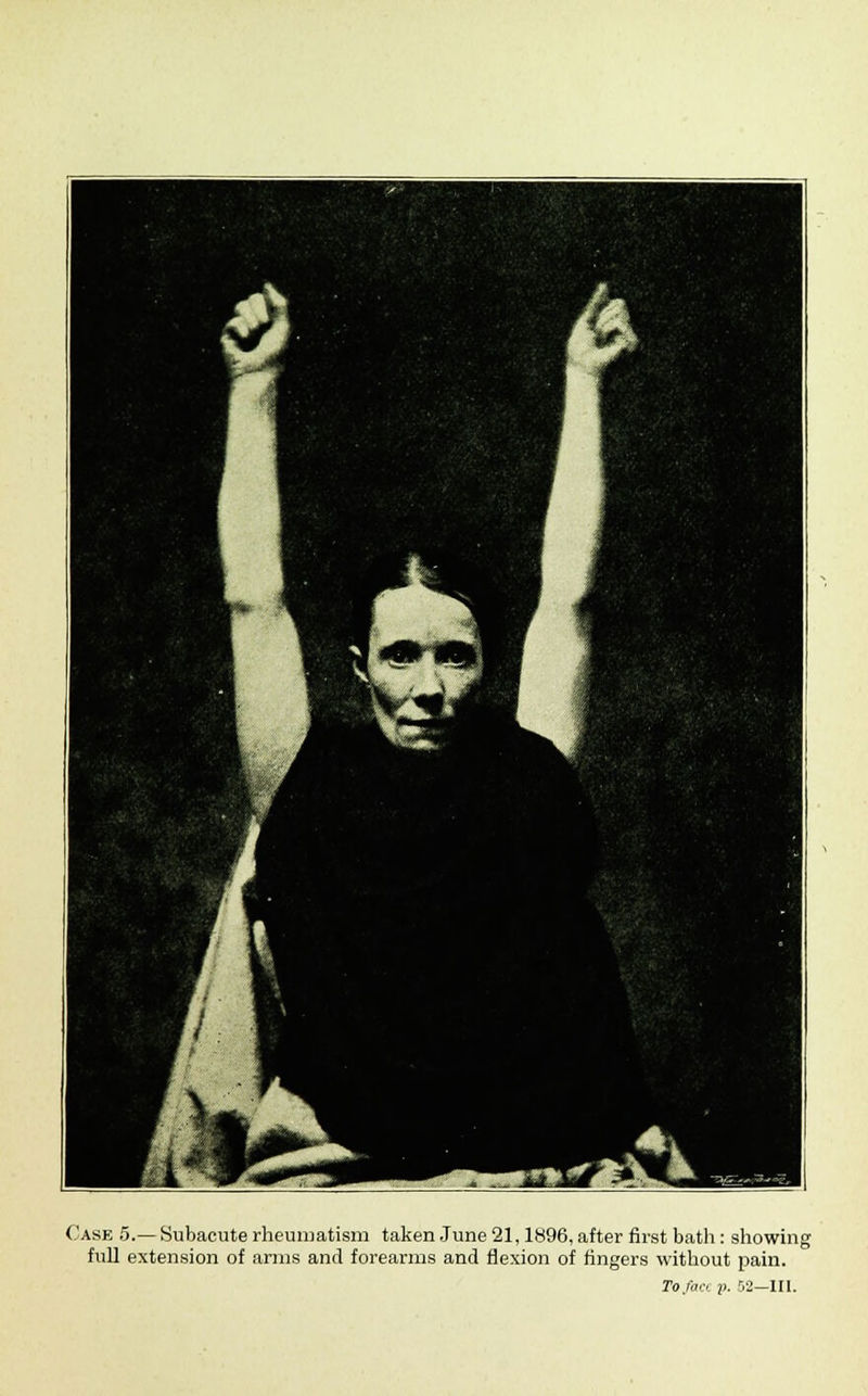 Case 5.— Subacute rheumatism taken June 21,1896, after first bath: showing full extension of arms and forearms and flexion of fingers without pain.